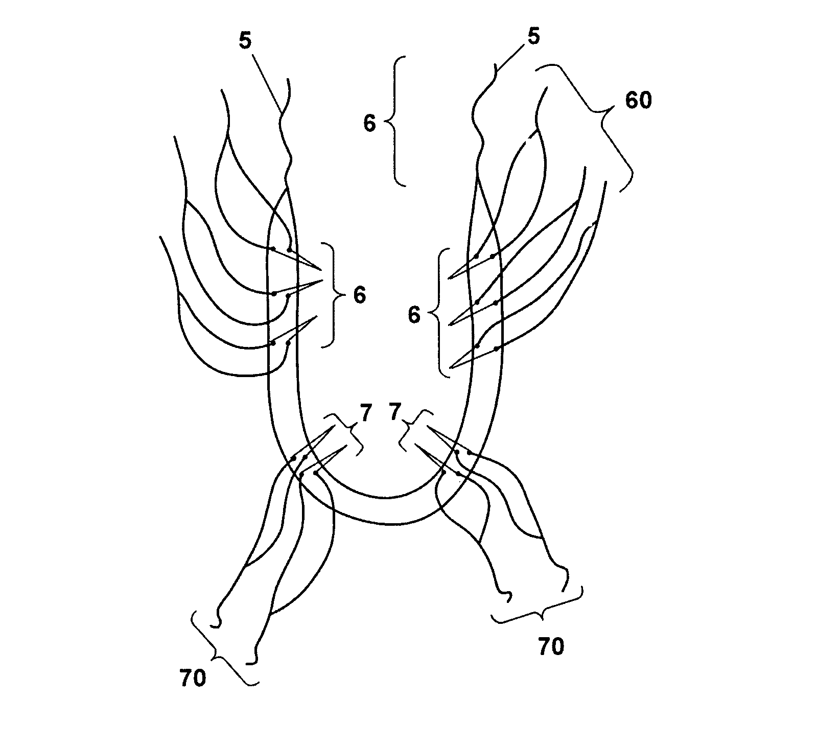 System for the treatment of stress urinary incontinence