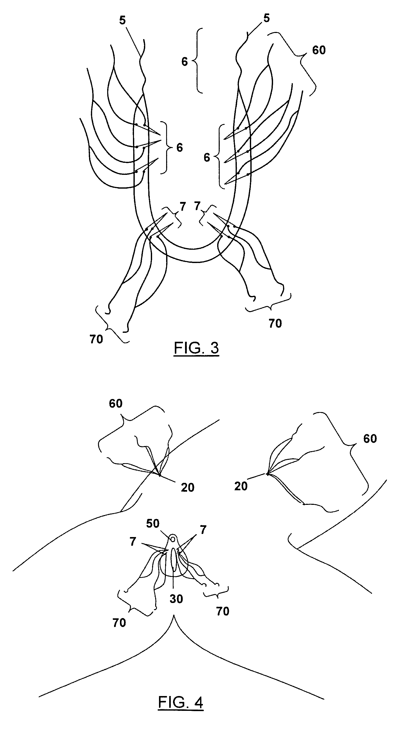 System for the treatment of stress urinary incontinence