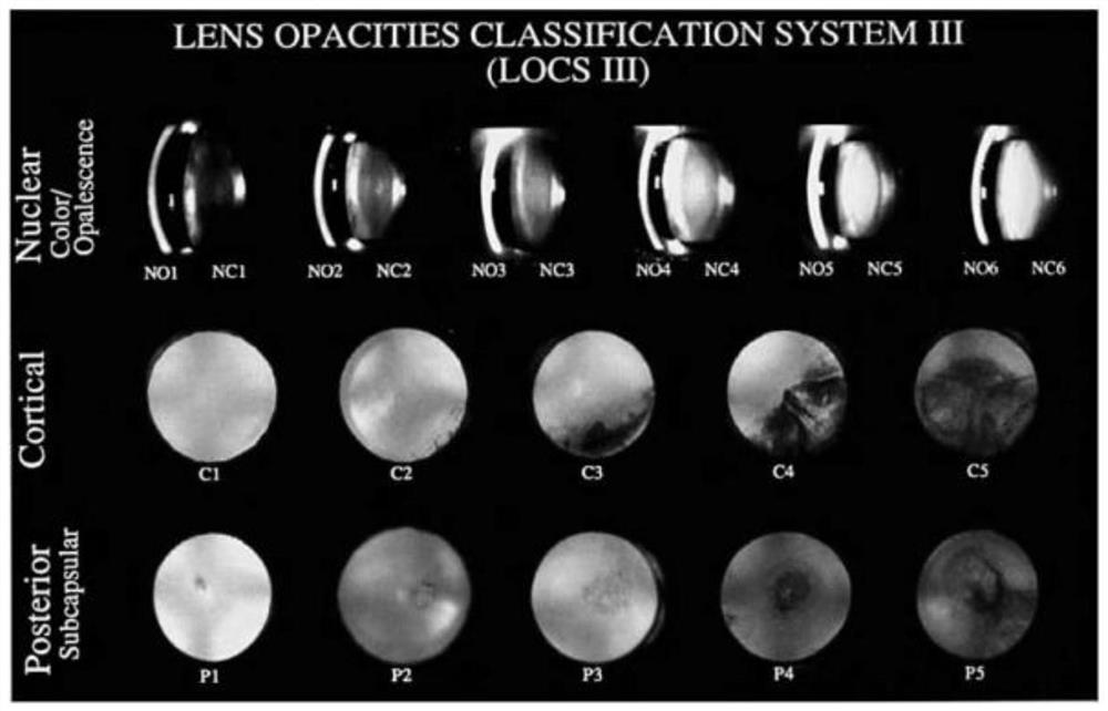 cataract patient visual impairment degree evaluation system based on AI technology