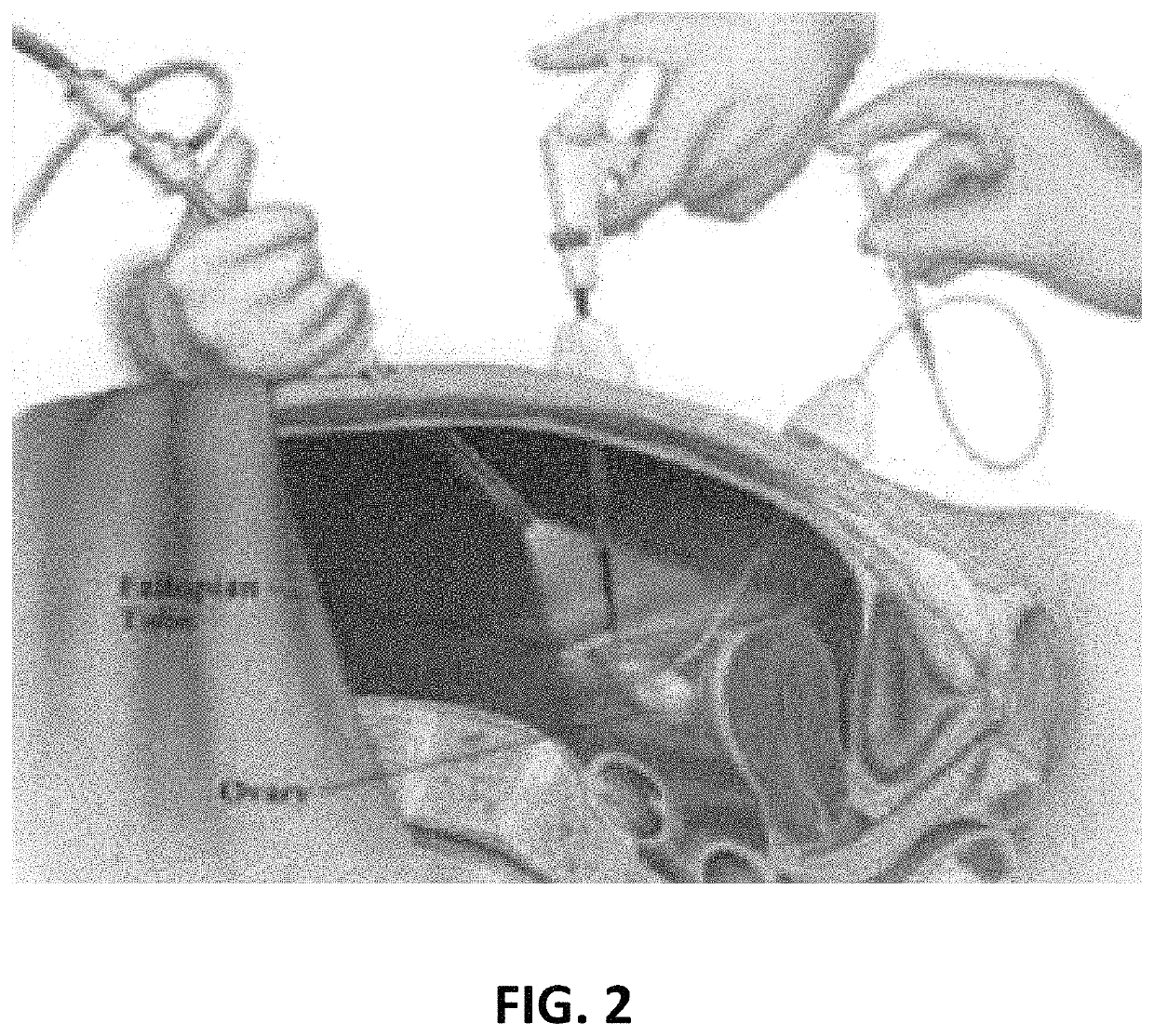 Catheter ultrasound transmission element (CUTE) catheter