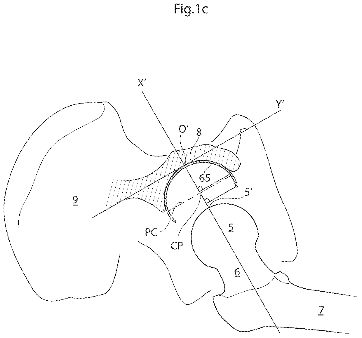 Hip joint device