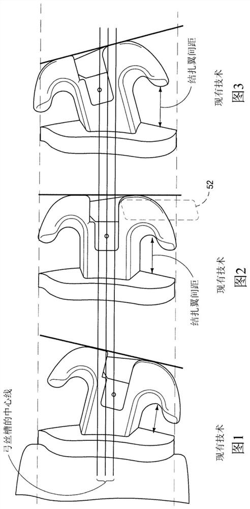 Orthodontic bracket apparatus and method for treating malocclusion