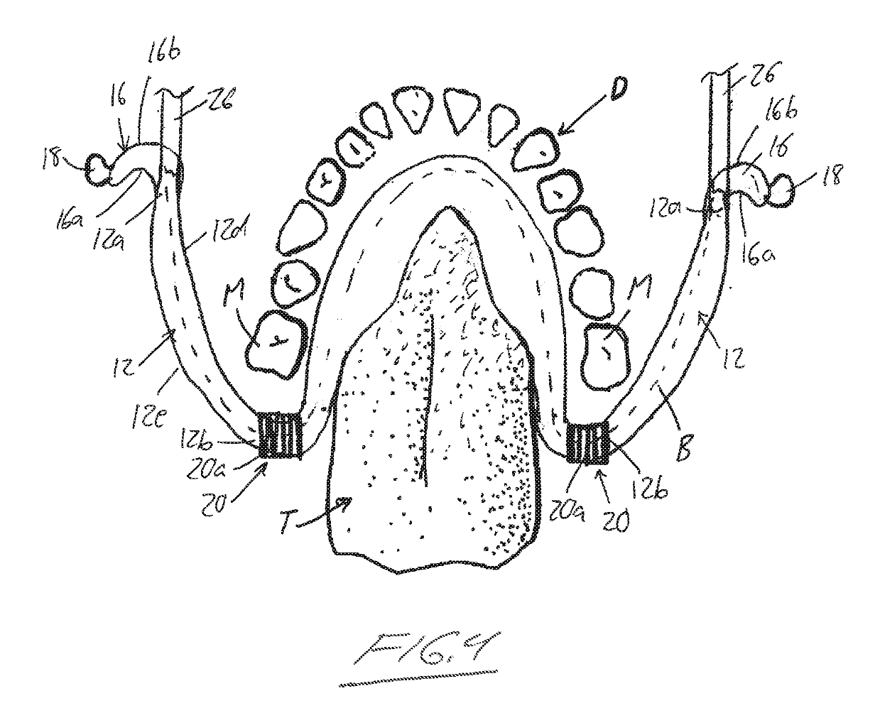 Intra-Oral Appliance for Field Isolation and Moisture Control