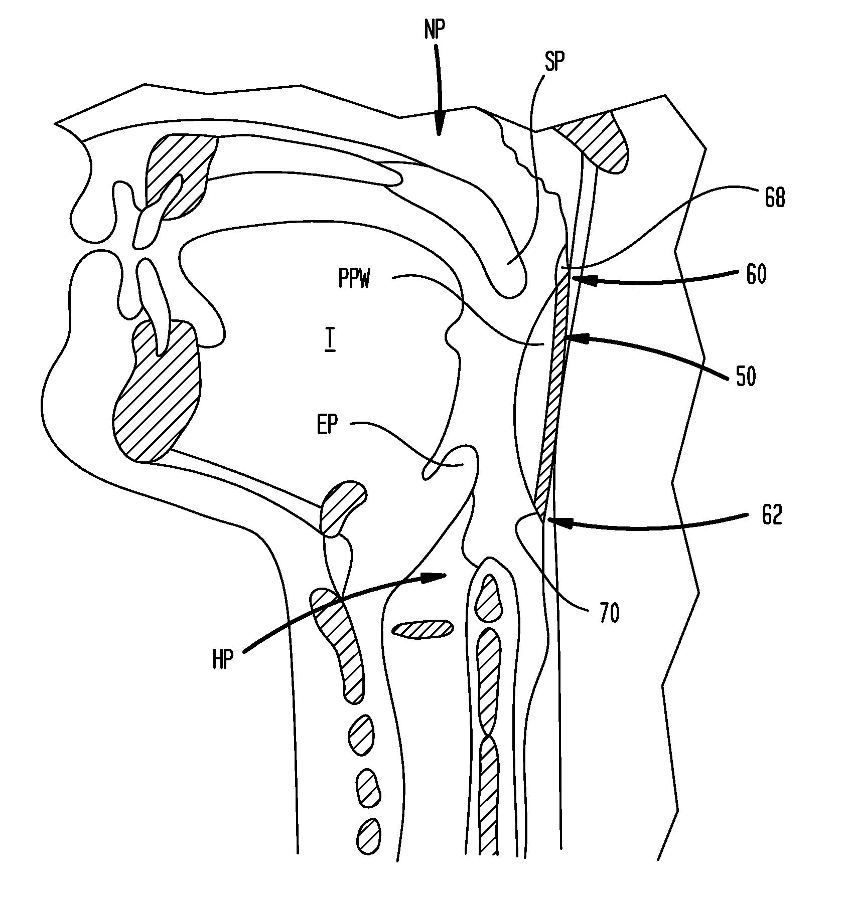 Methods and devices for forming an auxiliary airway for treating obstructive sleep apnea