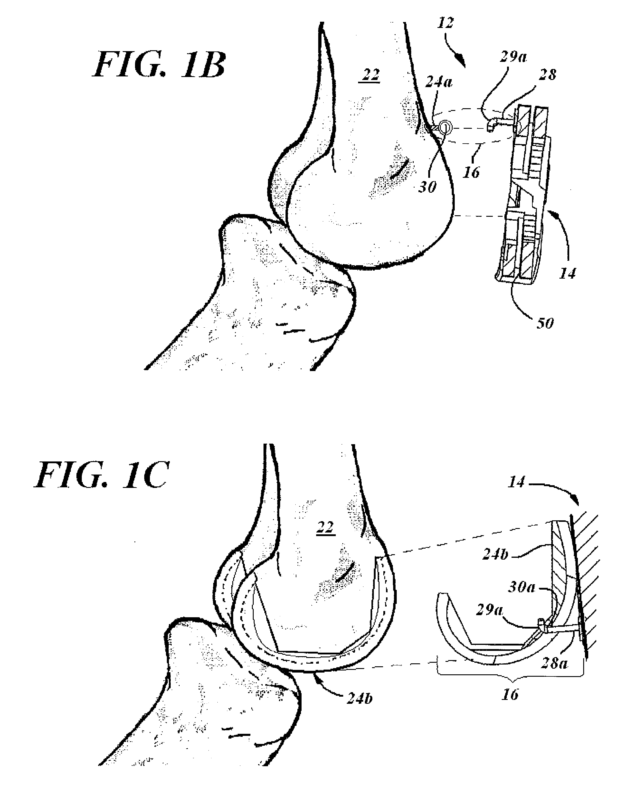 In situ patellar fixing system