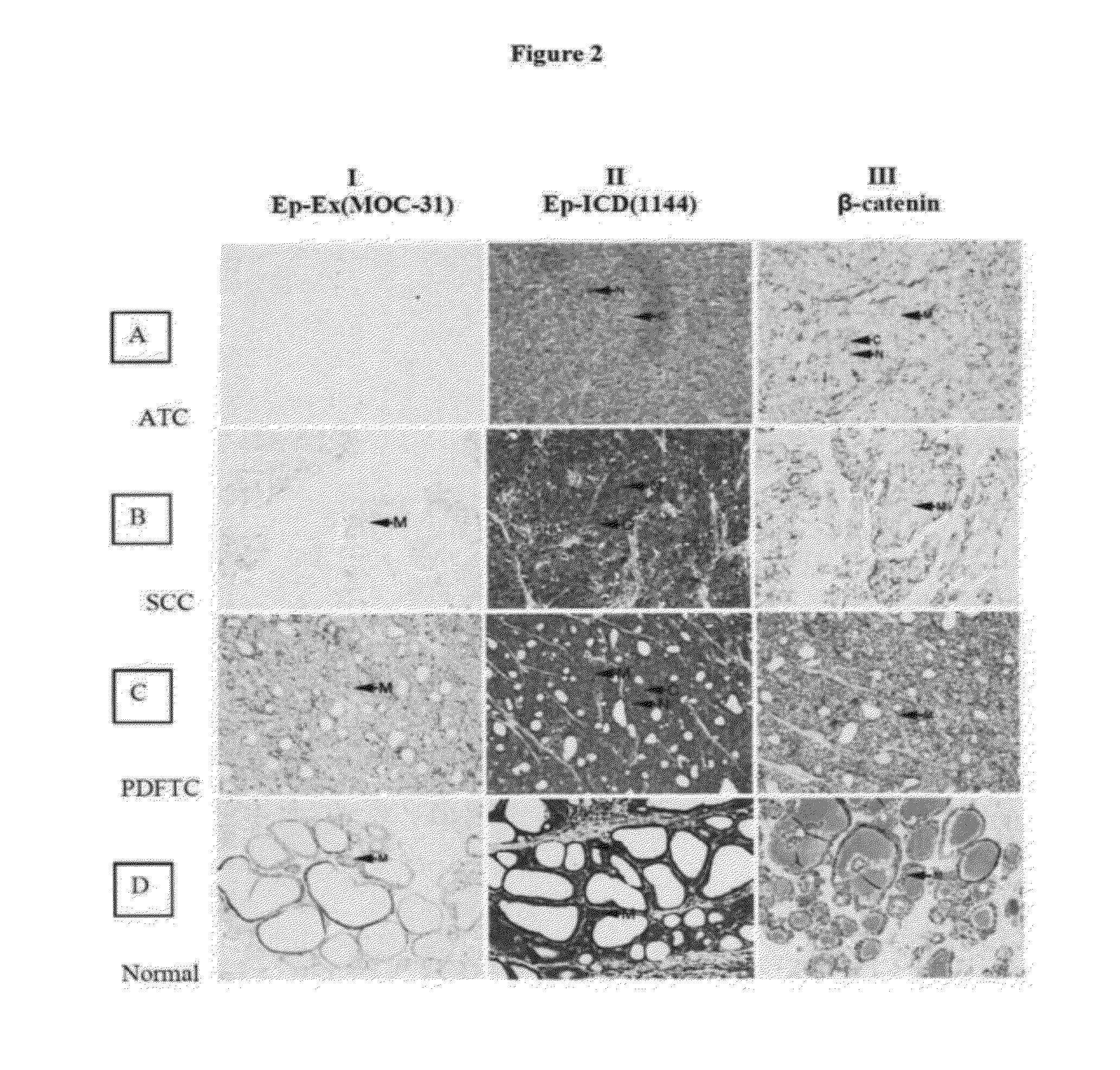 Methods and Compositions for the Diagnosis and Treatment of Thyroid Cancer