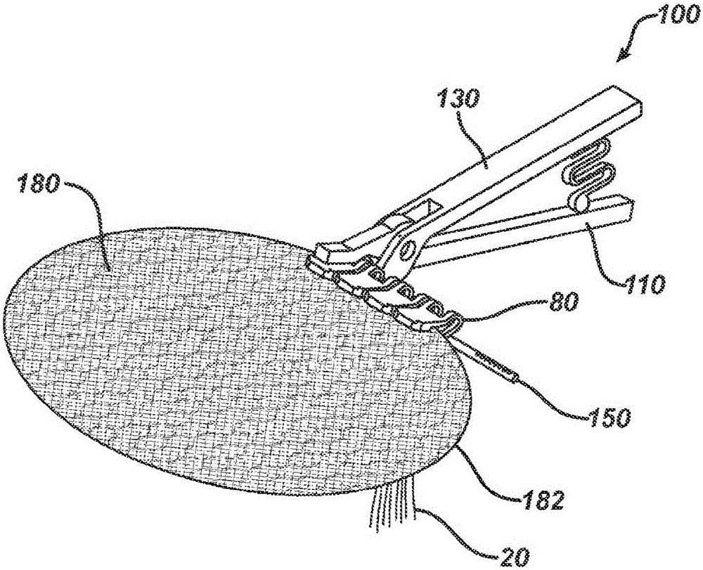 Method and means to attach anchor sutures onto mesh implants