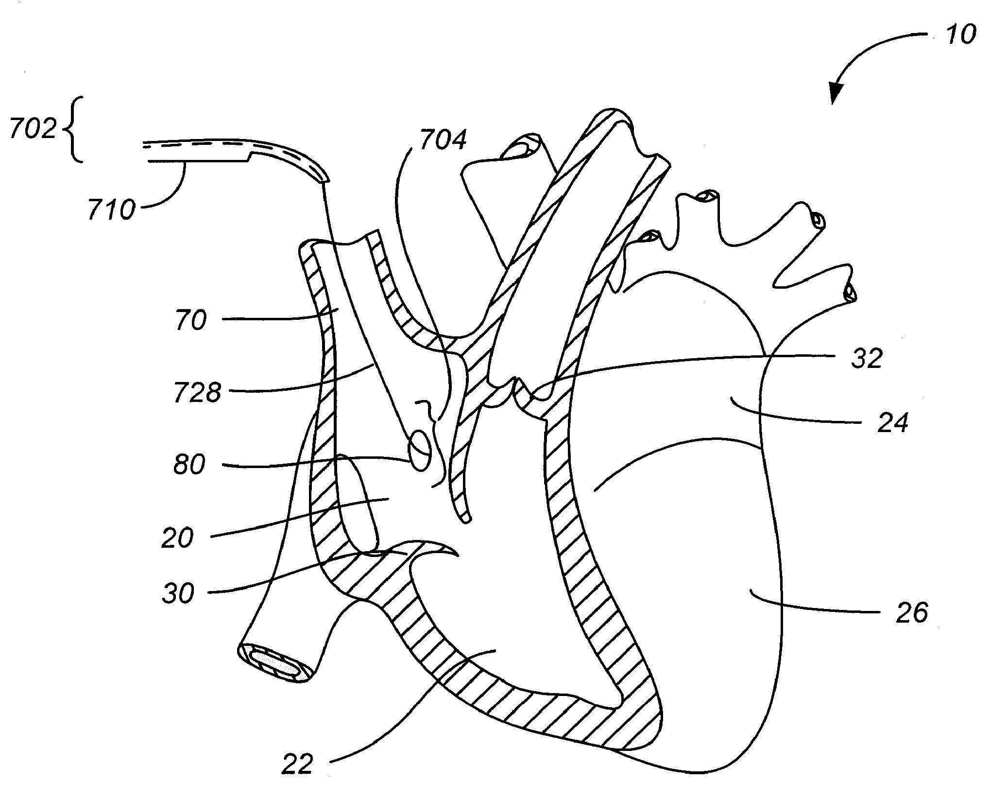 Transcoronary sinus pacing system, LV summit pacing, early mitral closure pacing, and methods therefor