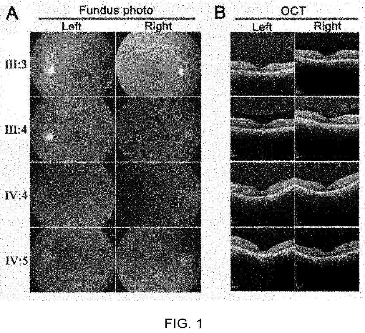 Use of ZNF124 Gene in Early Screening or Auxiliary Diagnosis of Retinitis Pigmentosa Disease