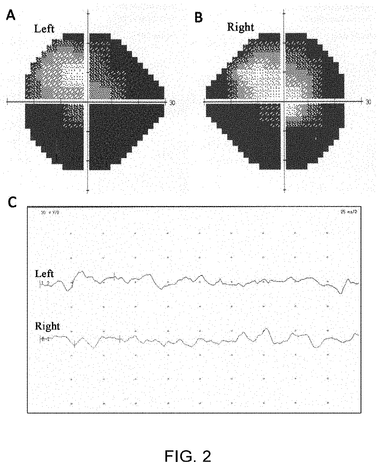 Use of ZNF124 Gene in Early Screening or Auxiliary Diagnosis of Retinitis Pigmentosa Disease