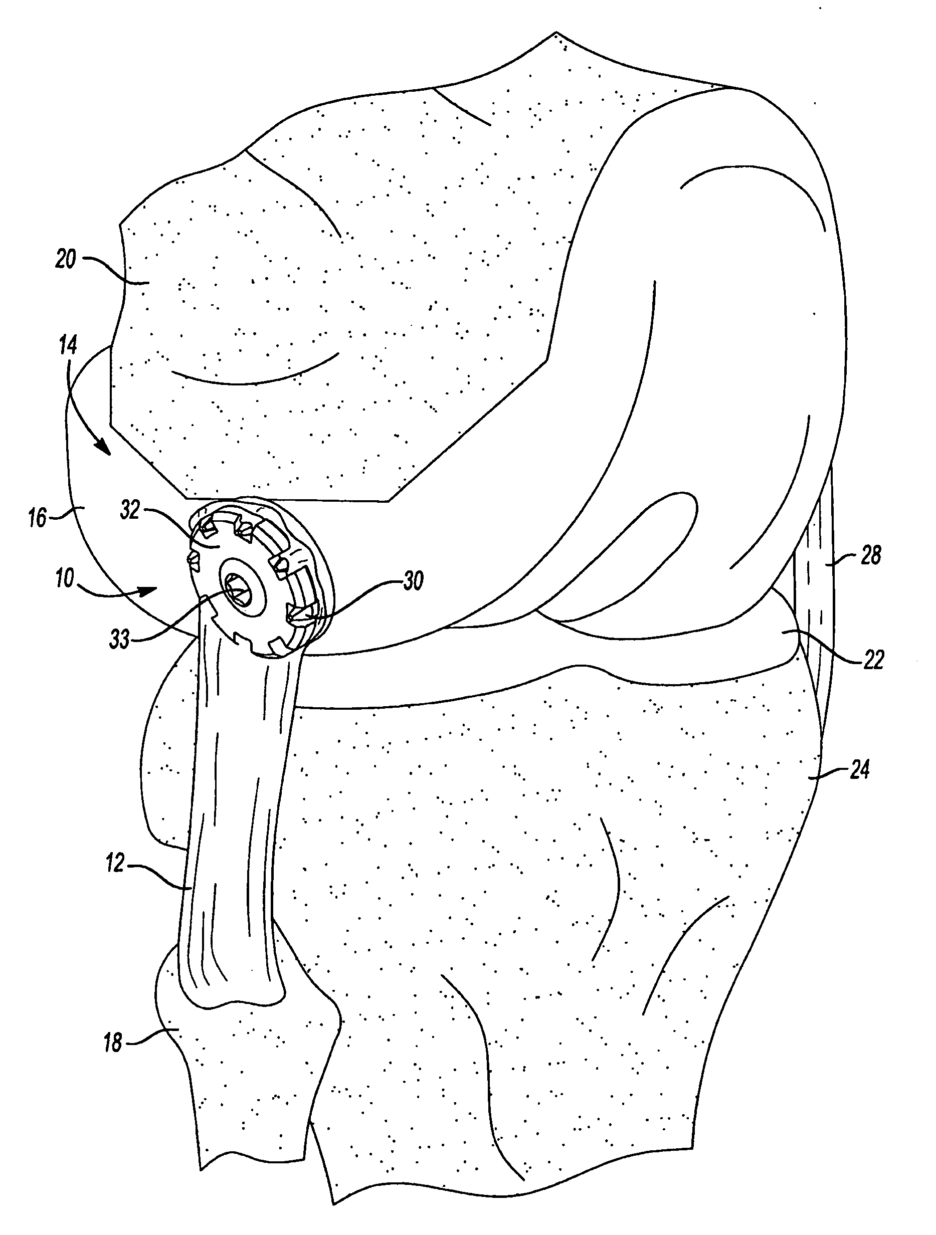 Method And Apparatus For Attaching Soft Tissue To An Implant