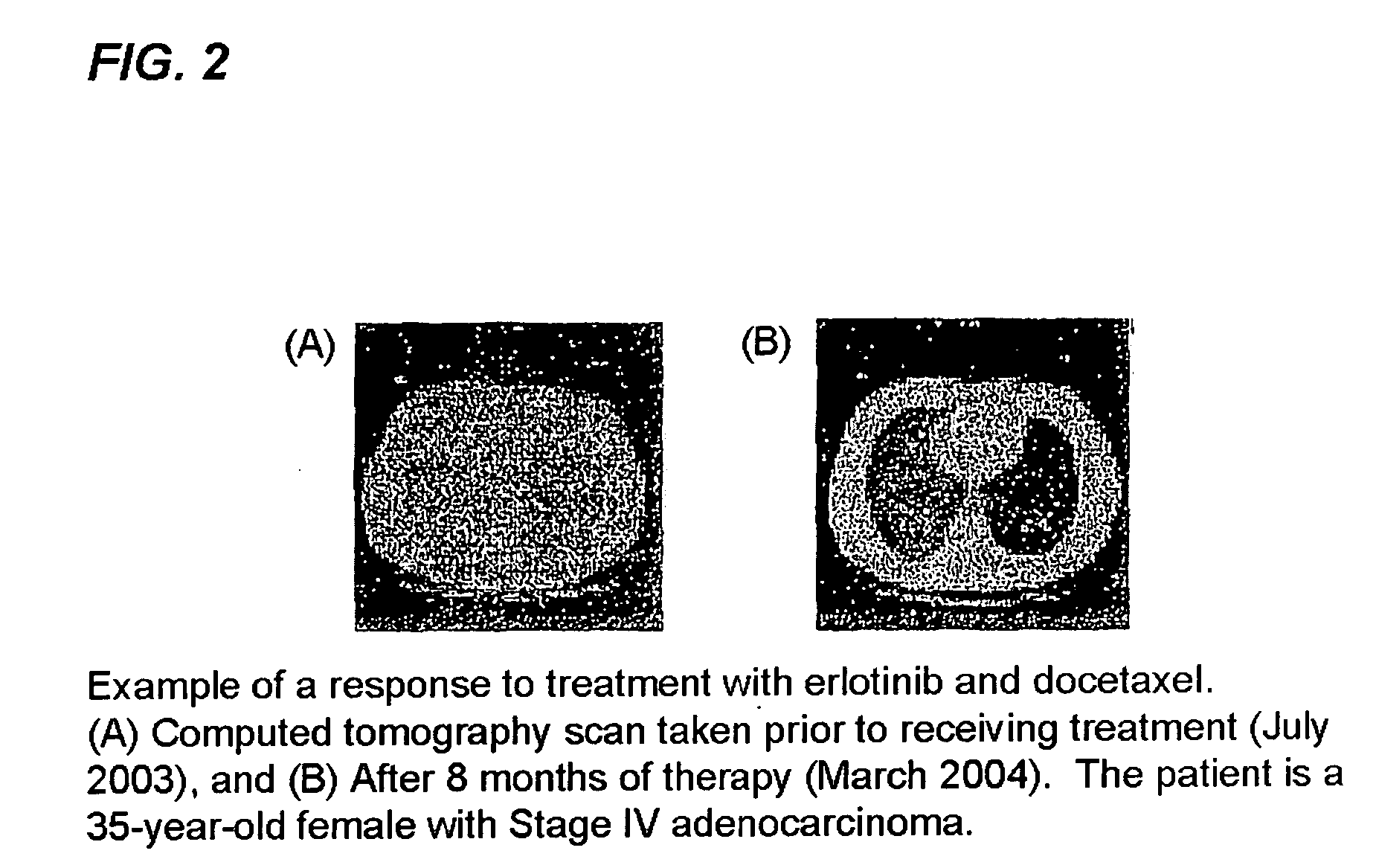 Combined treatment with docetaxel and an epidermal growth factor receptor kinase inhibitor using an intermittent dosing regimen