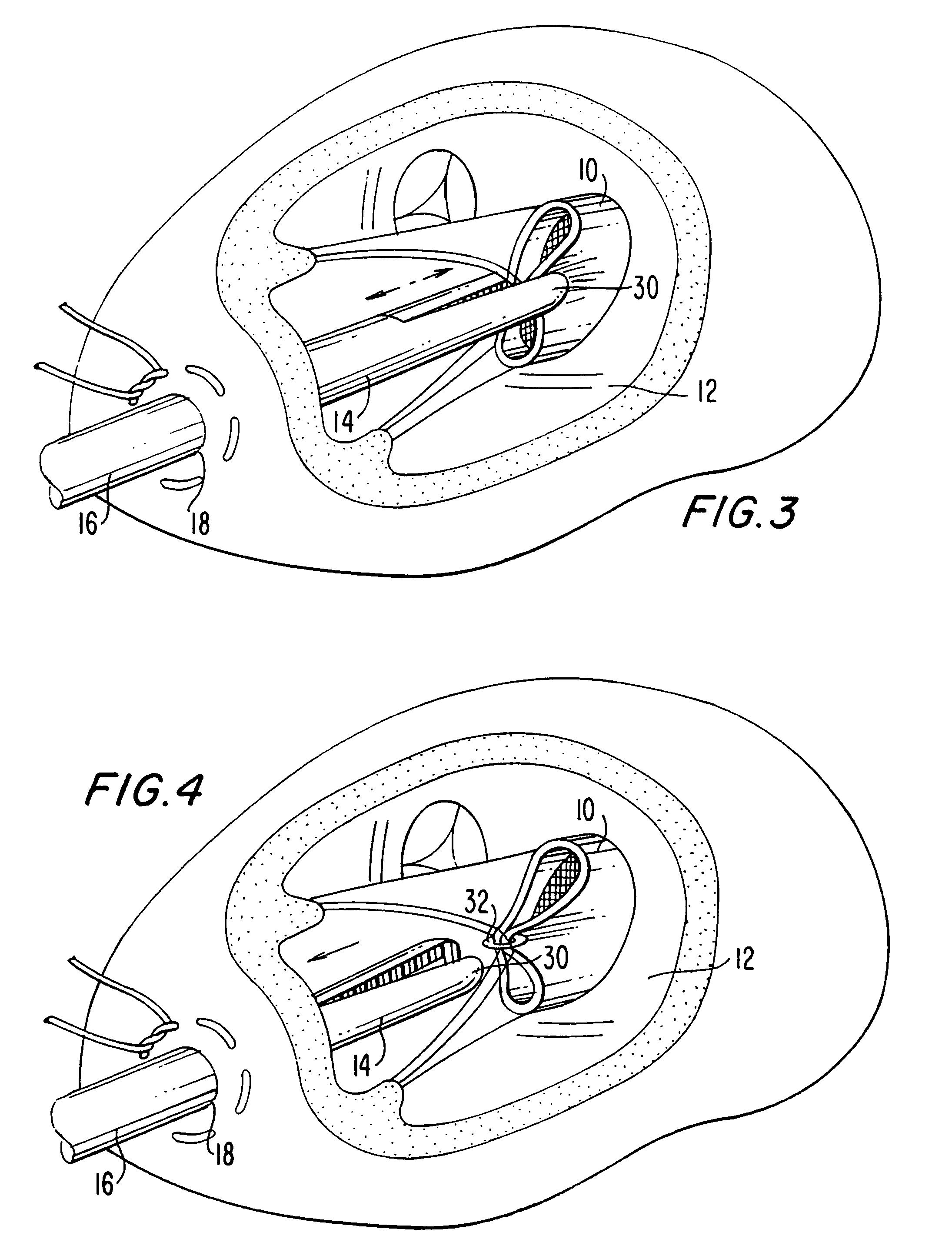 Method and apparatus for circulatory valve repair