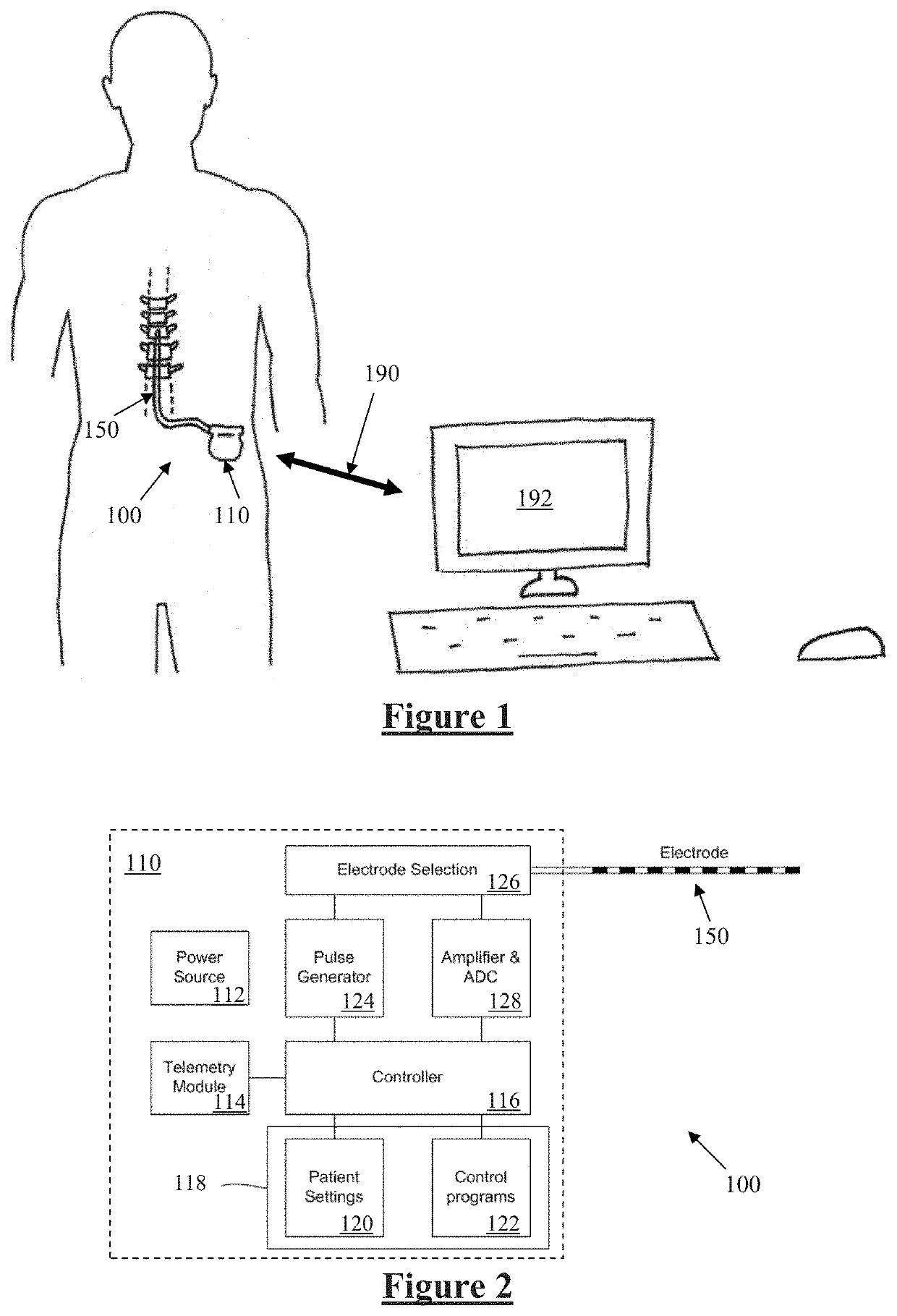 Neurostimulation Artefact Minimisation