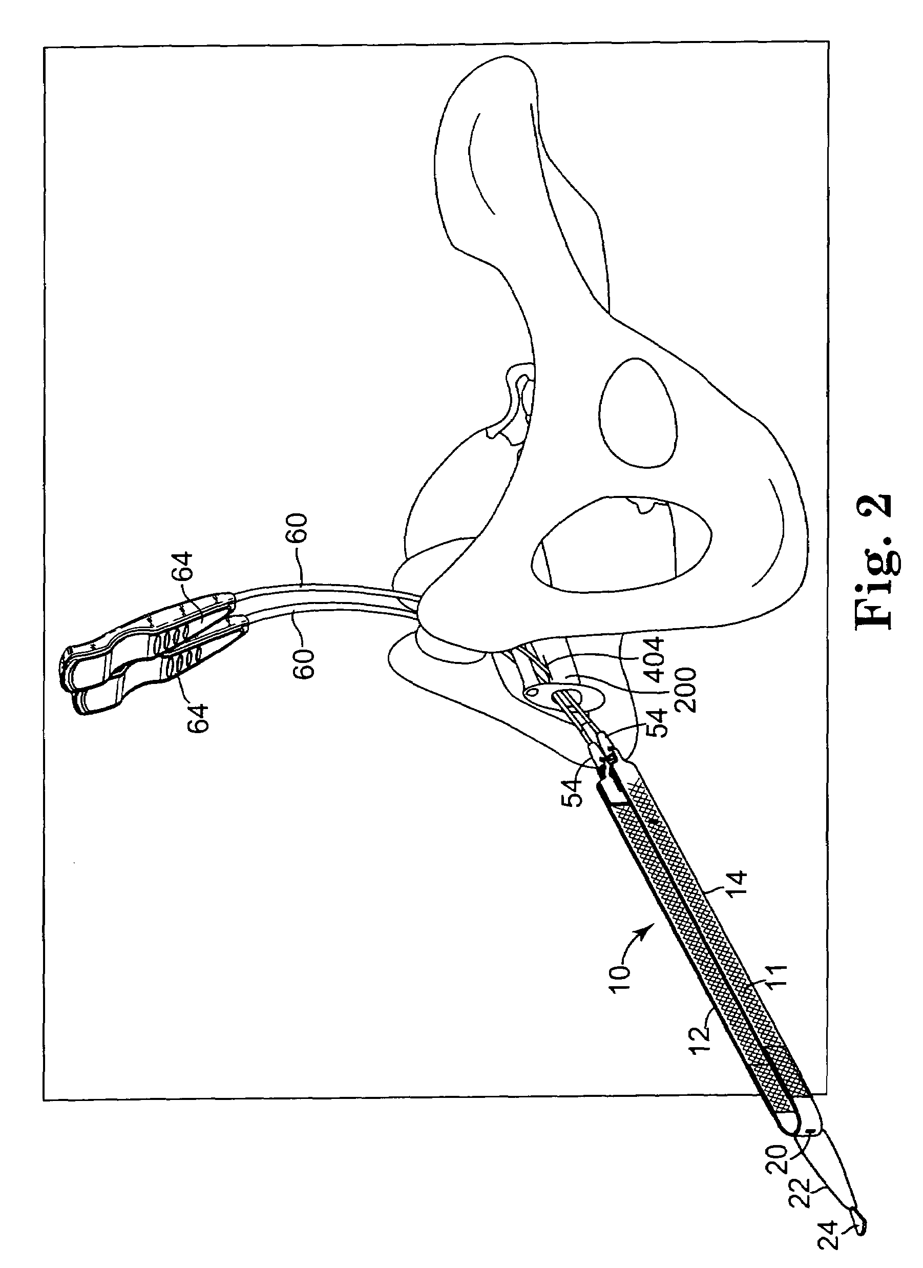 Surgical article and methods for treating female urinary incontinence