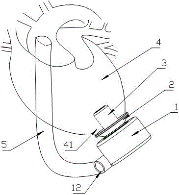 A ventricular connection component