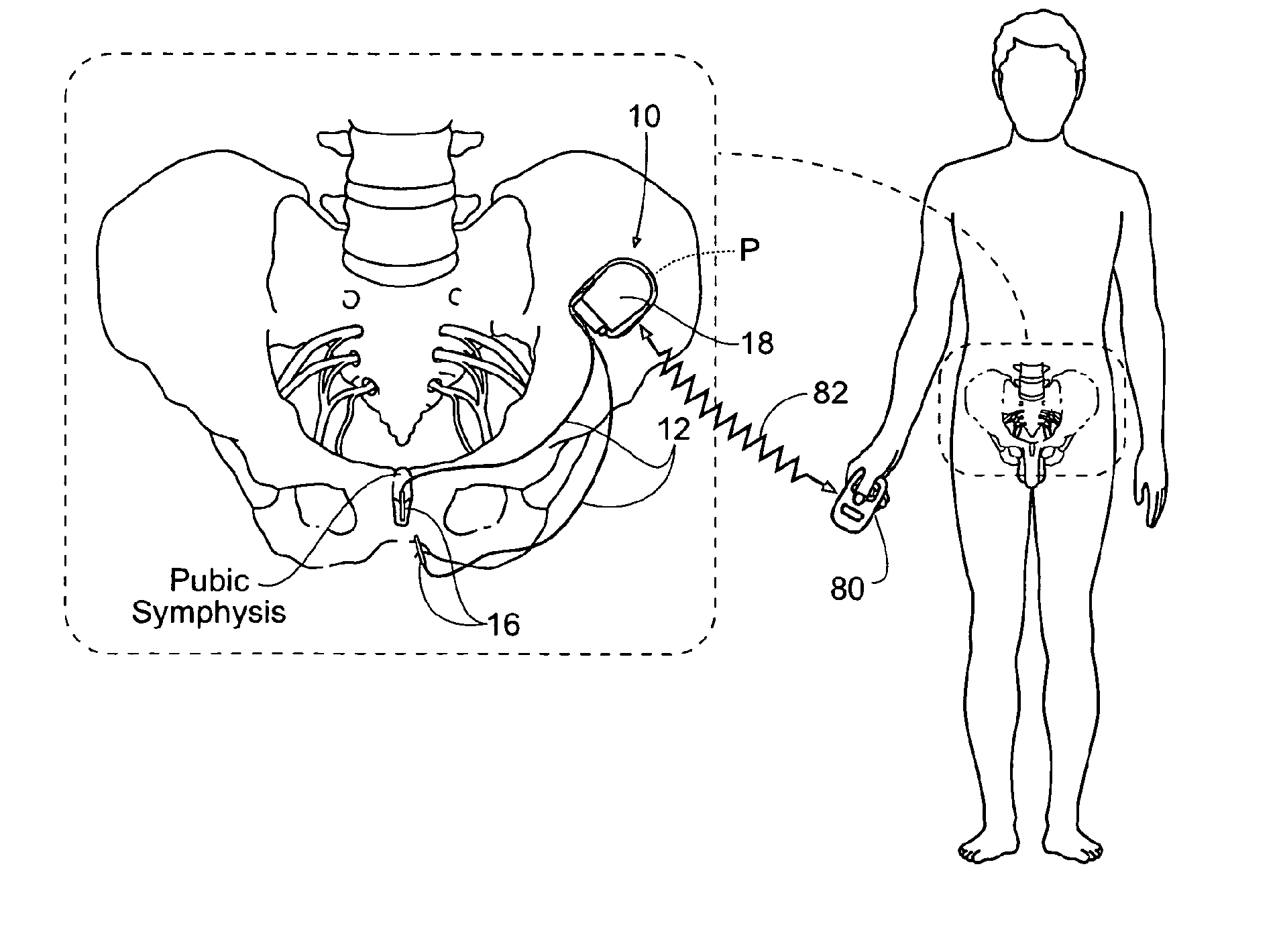 Systems and methods for the treatment of bladder dysfunctions using neuromodulation