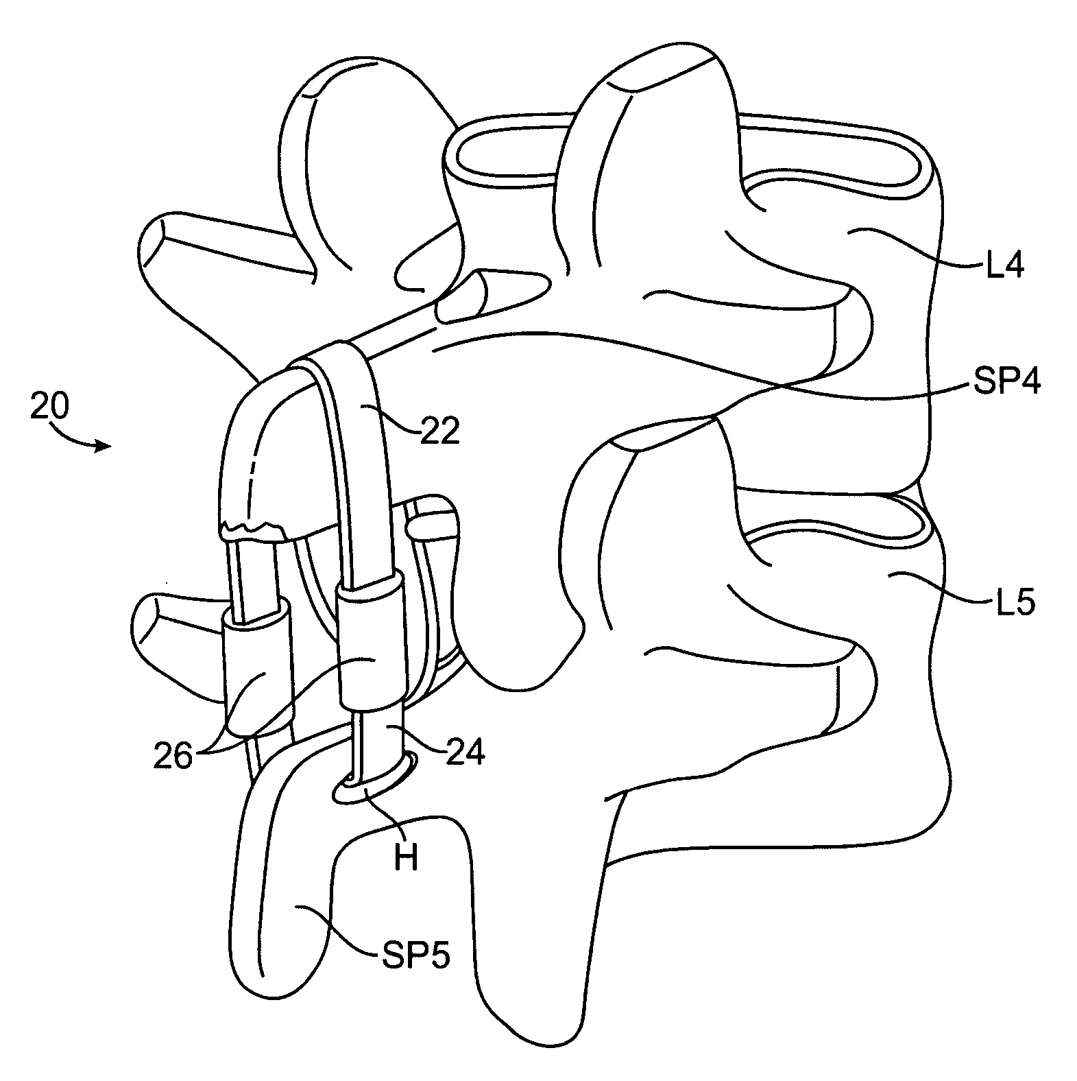 Methods and systems for constraint of spinous processes with attachment