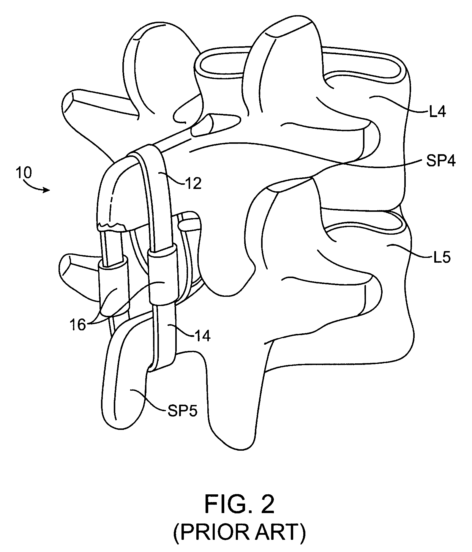 Methods and systems for constraint of spinous processes with attachment