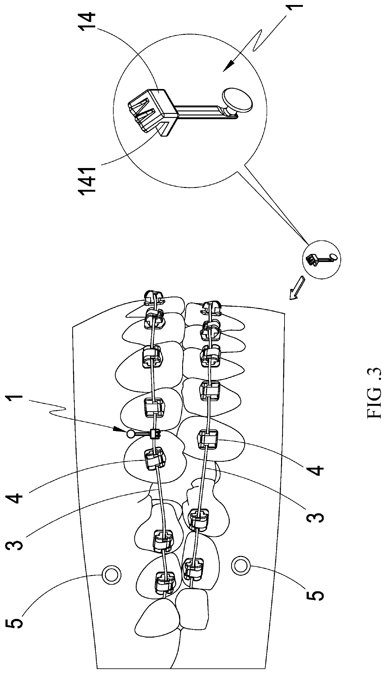 Dental traction device