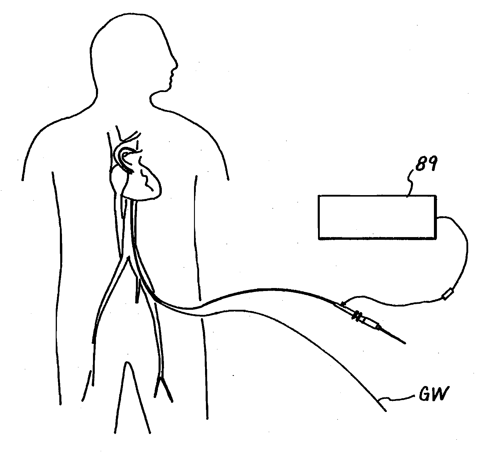 Tissue Penetrating Catheters having Integral Imaging Transducers and Their Methods of Use