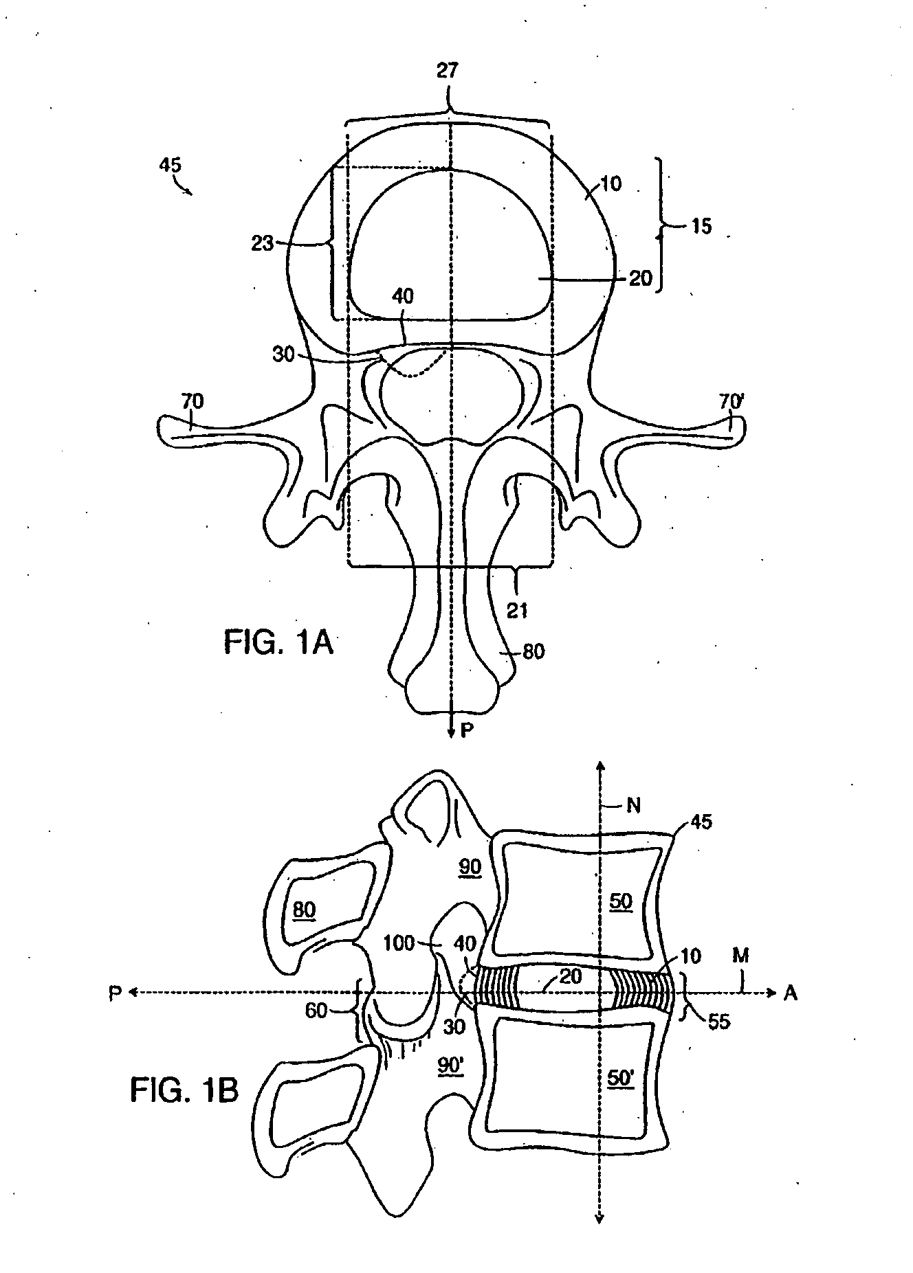 Method of anchoring an implant in an intervertebral disc