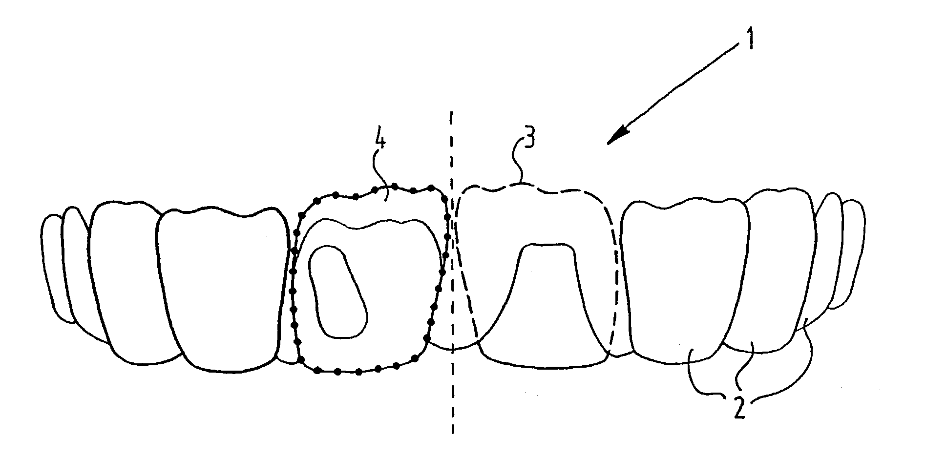 Method for production of an artificial tooth