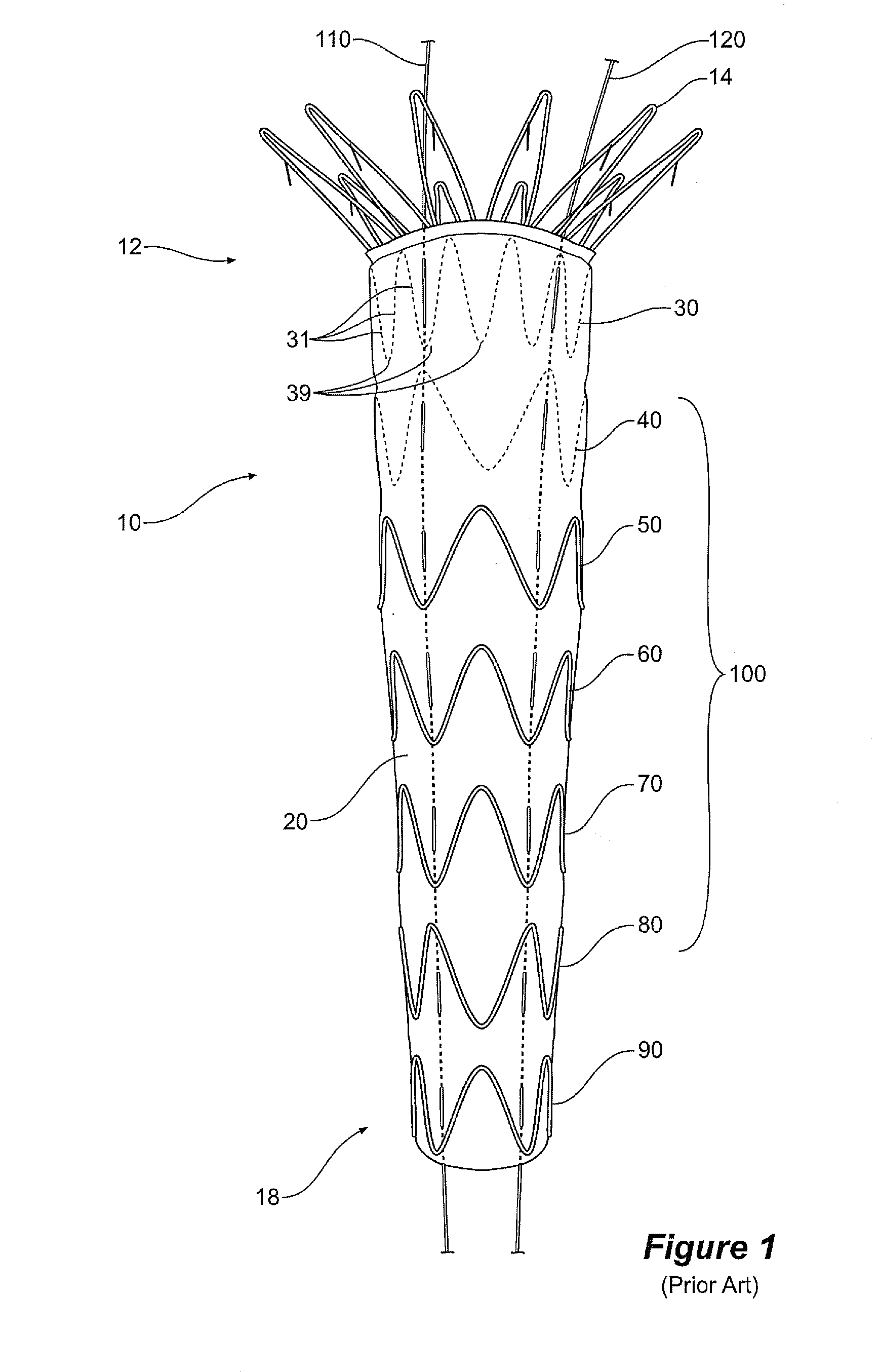 Assembly of stent grafts with diameter reducing ties