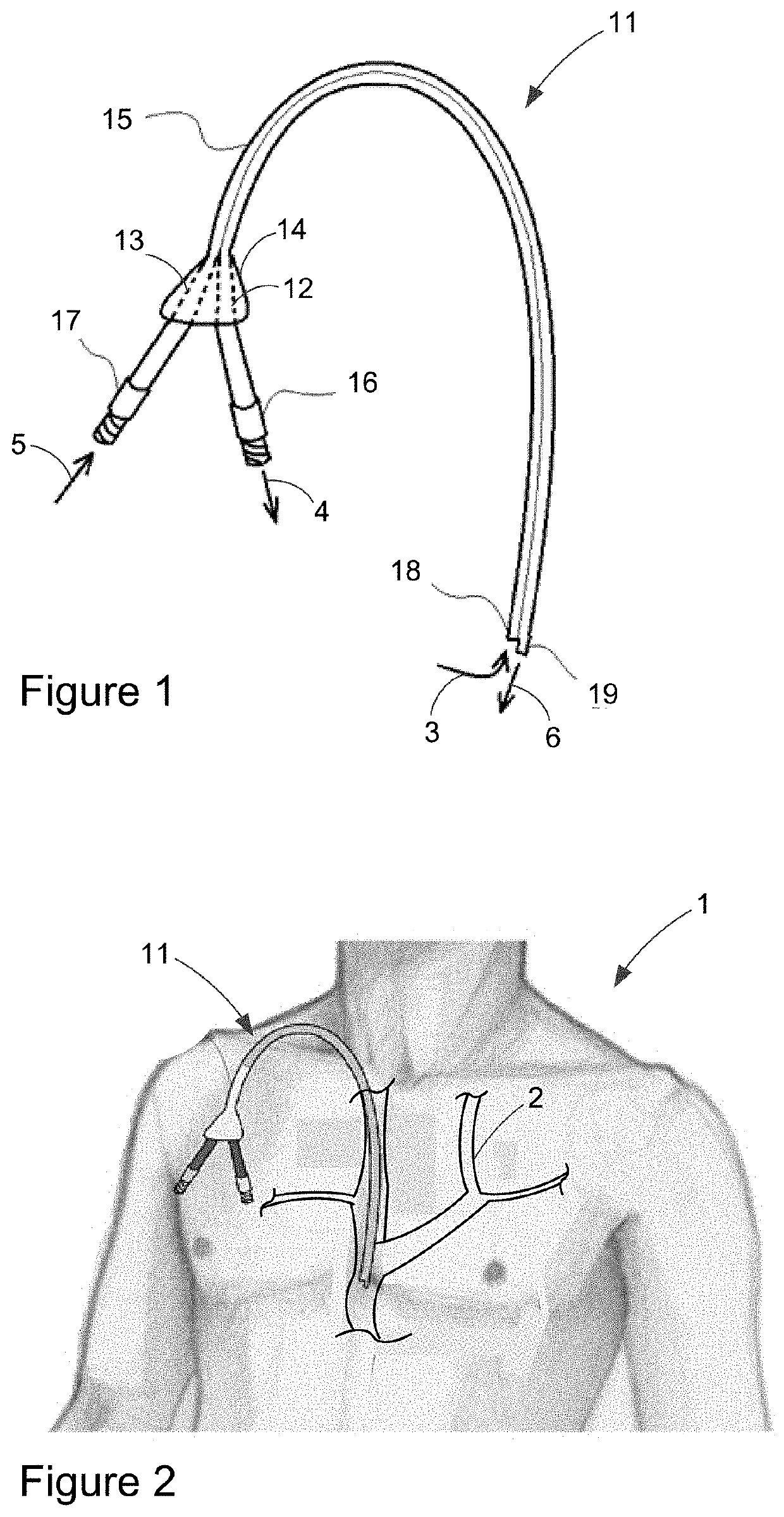 Catheter Clearance Device and Method of Use