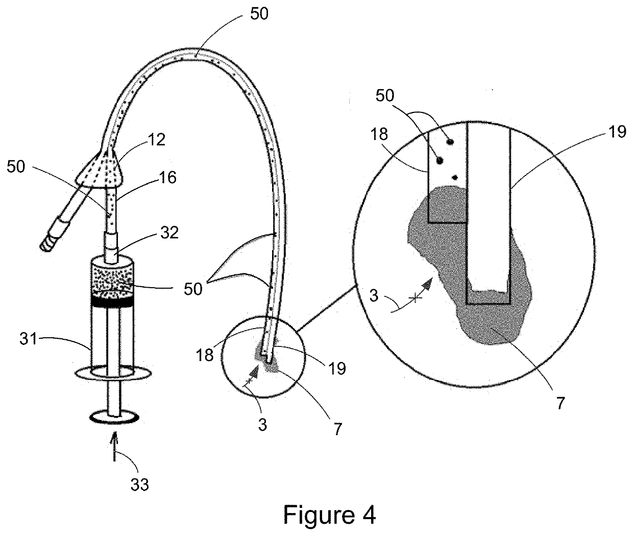 Catheter Clearance Device and Method of Use