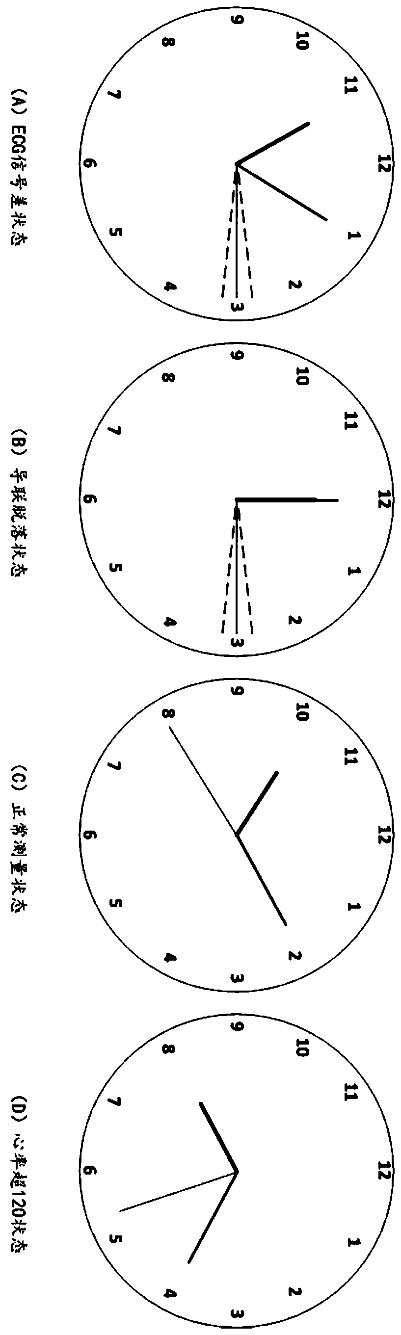 Pointer type electrocardio watch and electrocardio monitoring system