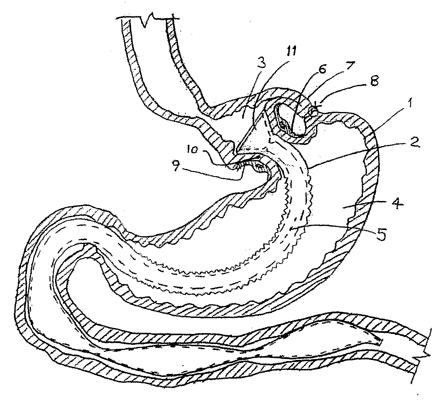 Gastric bypass prosthesis fixation system and method for treatment of obesity