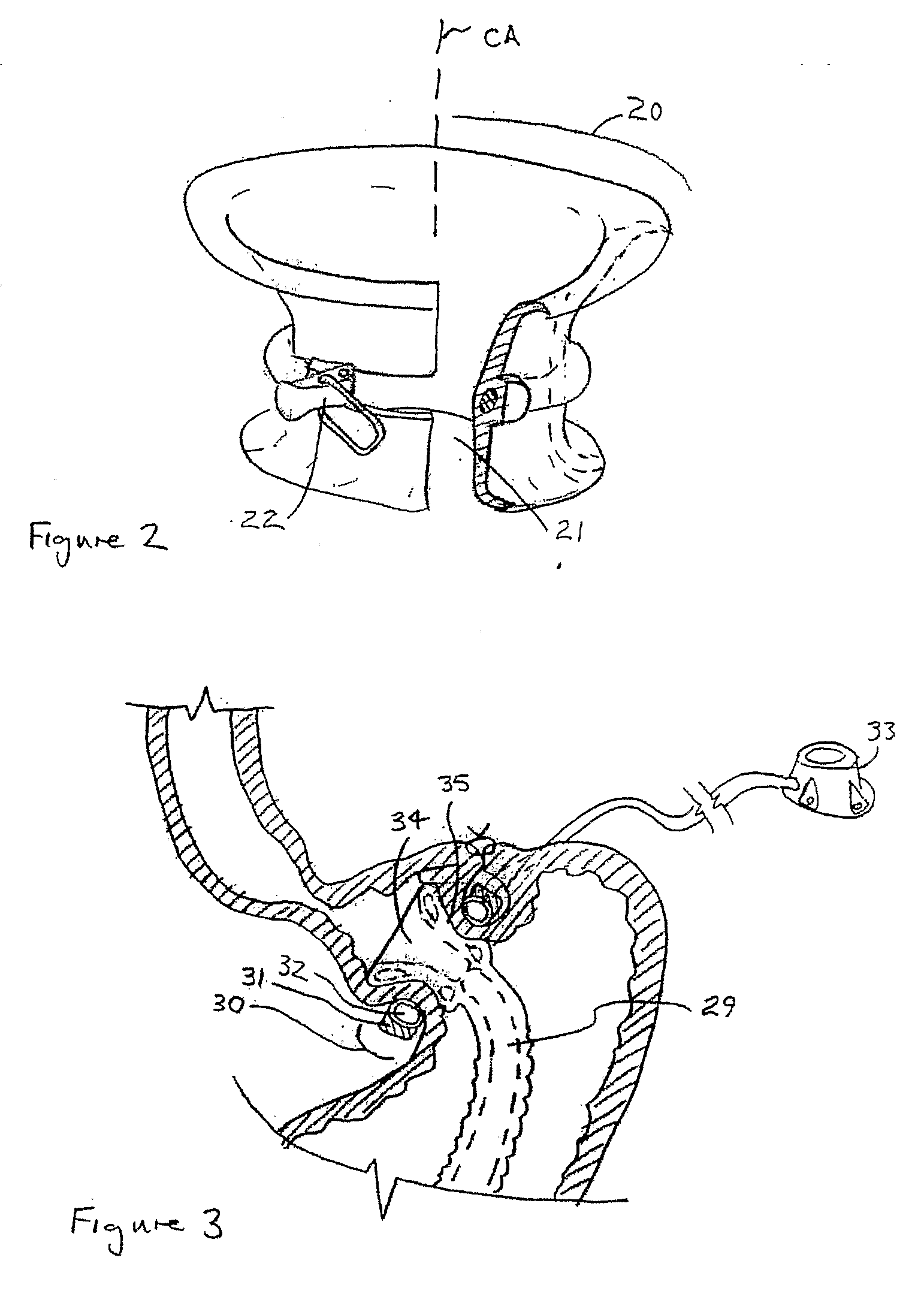 Gastric bypass prosthesis fixation system and method for treatment of obesity