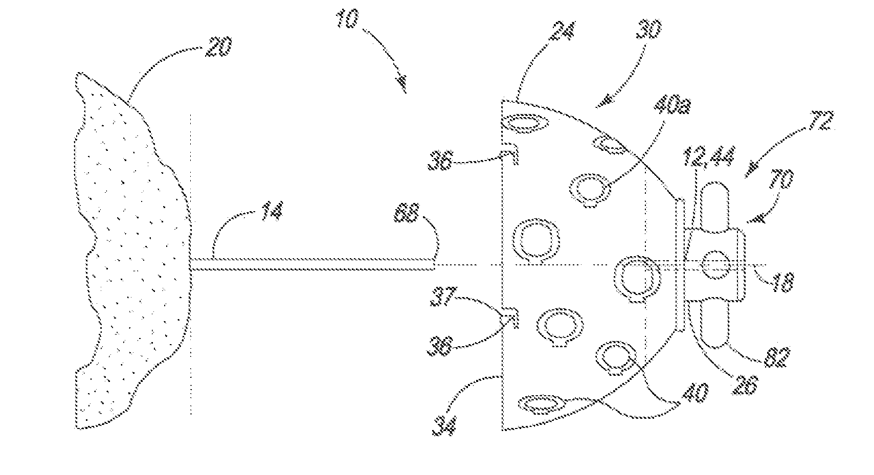 Guided reamer system for reshaping bone