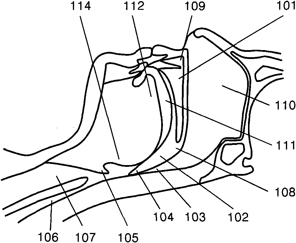 Adjustable soft palate supporting body and implantation method thereof