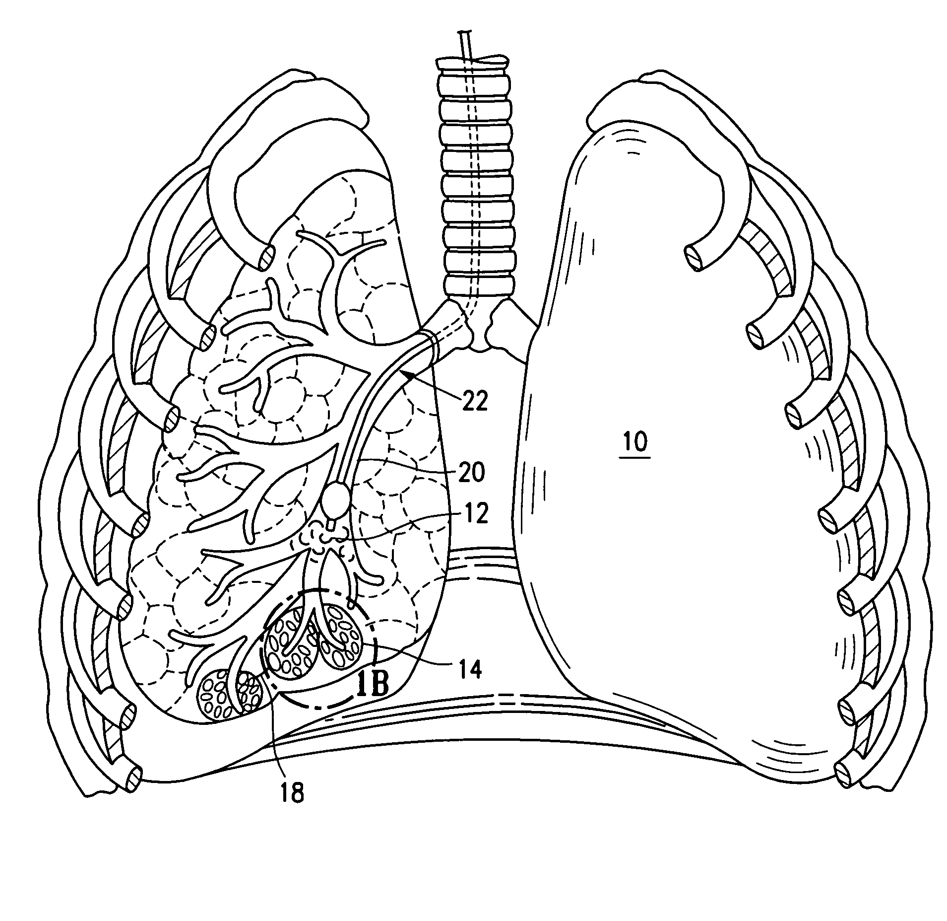 Device and method for lung treatment