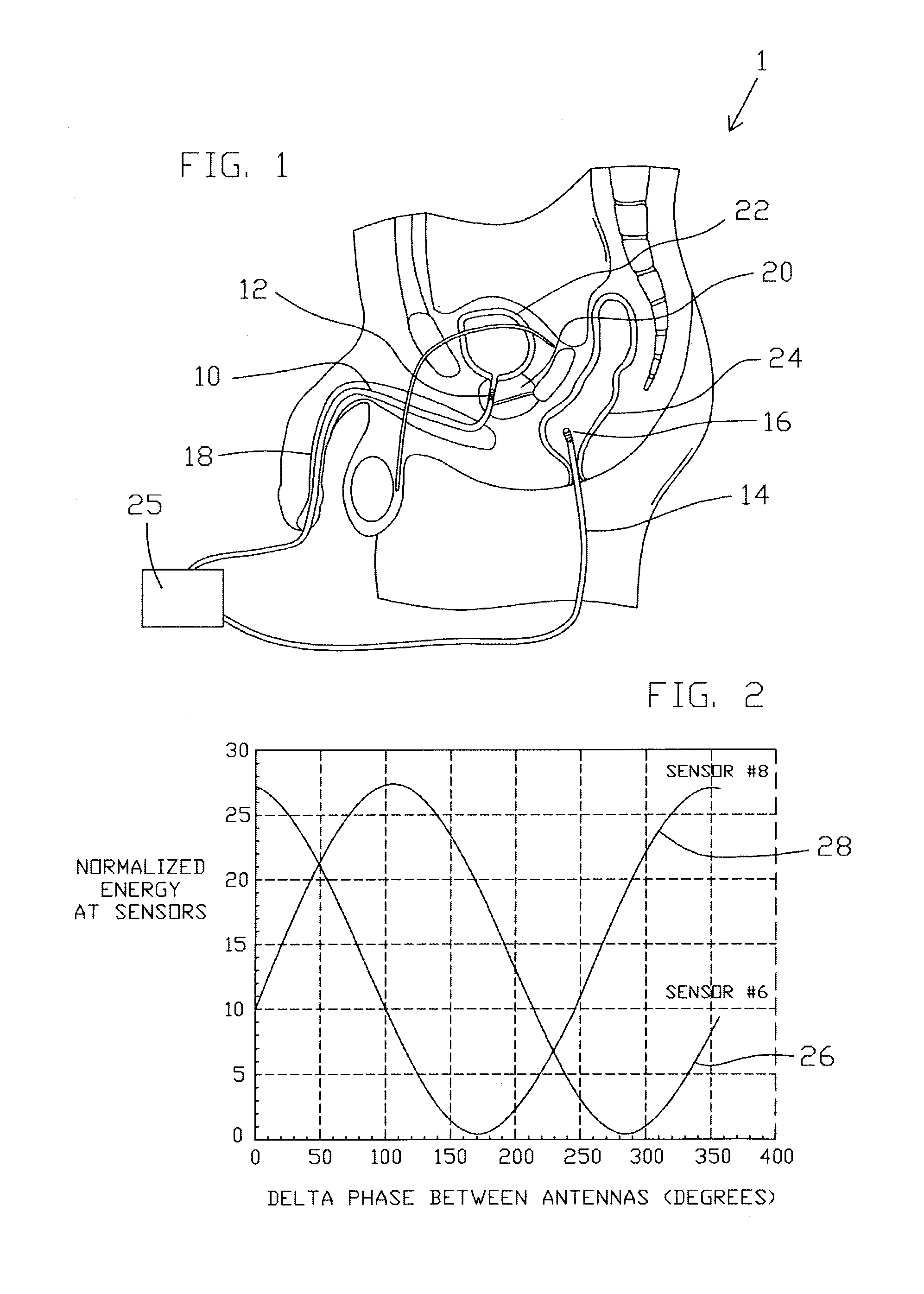 Microwave medical treatment apparatus and method