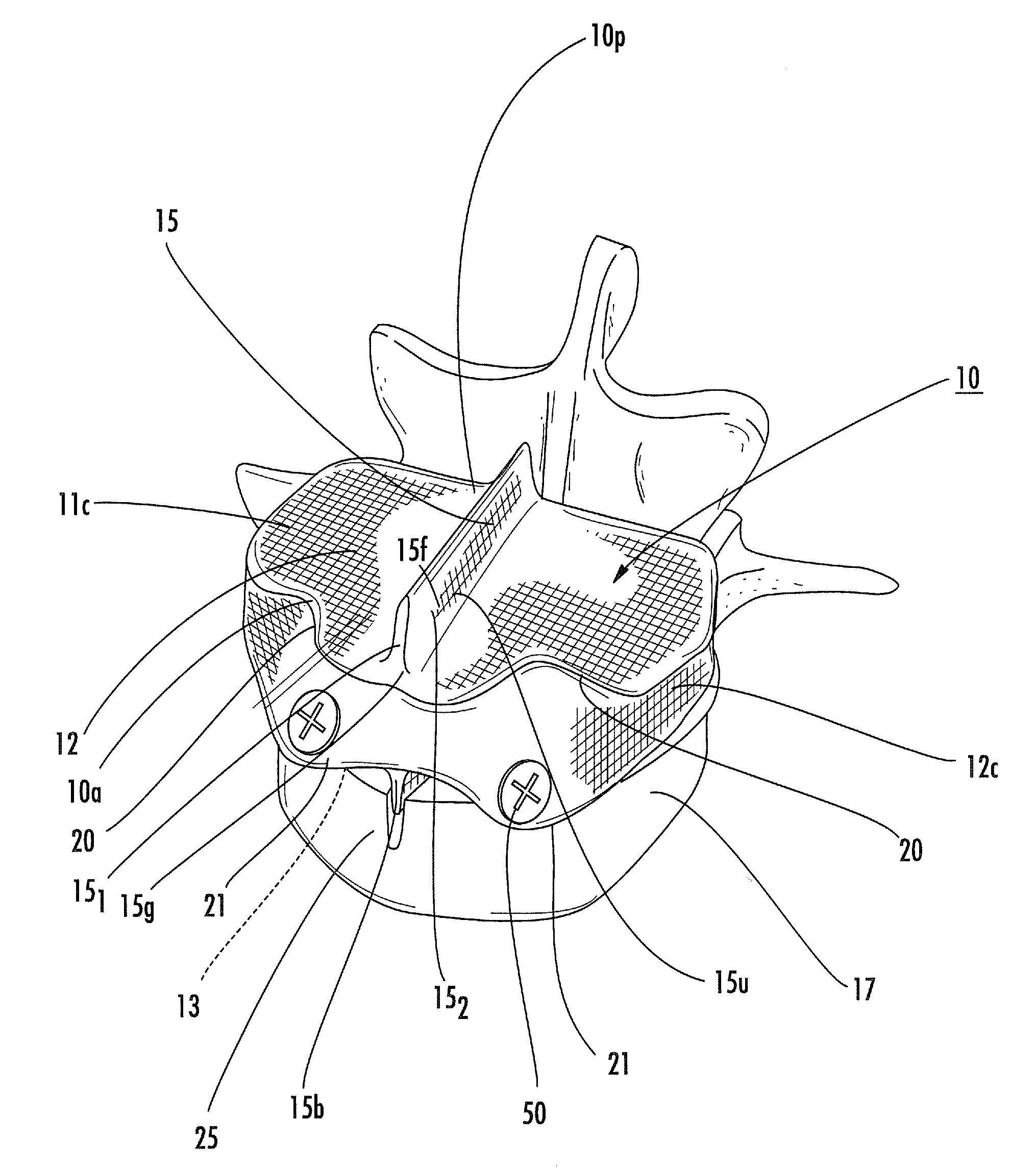 Spinal disc implants with flexible keels and methods of fabricating implants