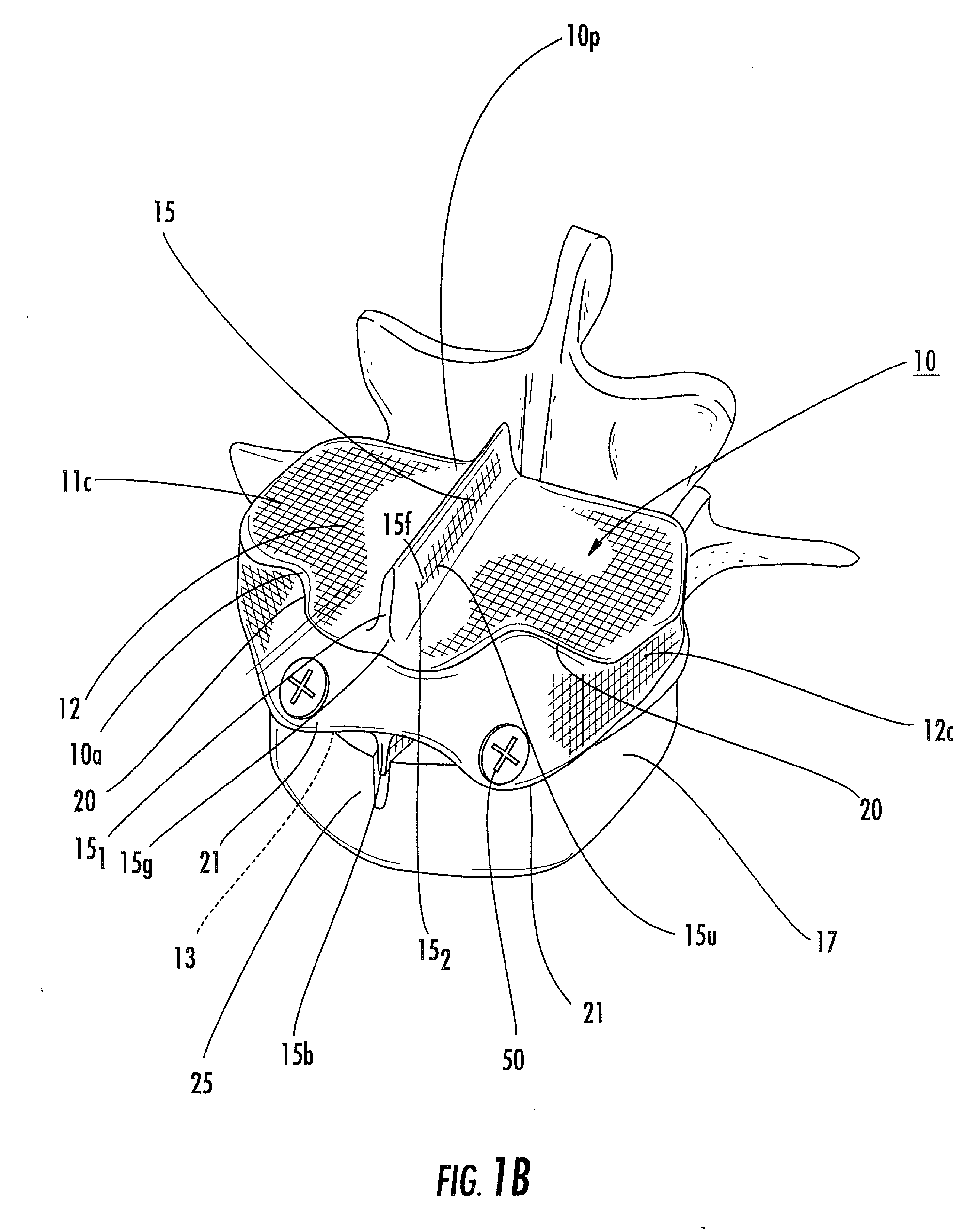 Spinal disc implants with flexible keels and methods of fabricating implants