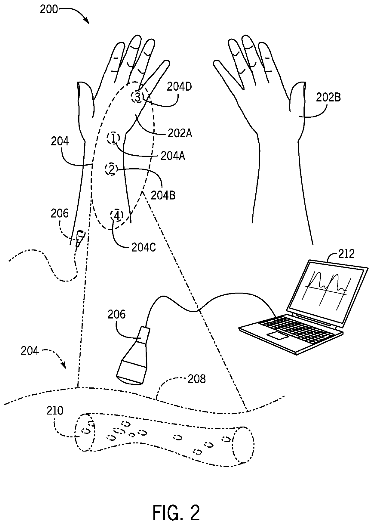 Computer-supported intraneural facilitation for vascular changes