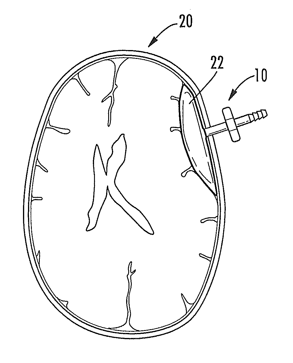 Subdural Drainage Catheter with Self Contained Mechanism for Restoration of Flow Following Catheter Obstruction