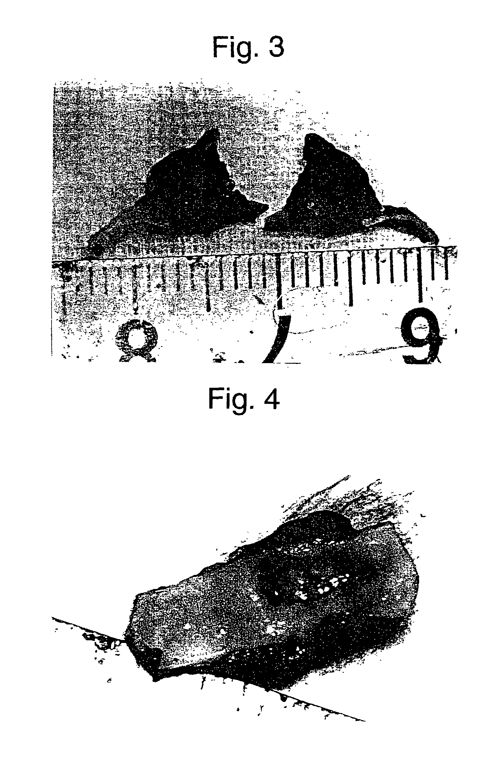 Vessel embolic material comprising hydrogel and therapy with the use thereof