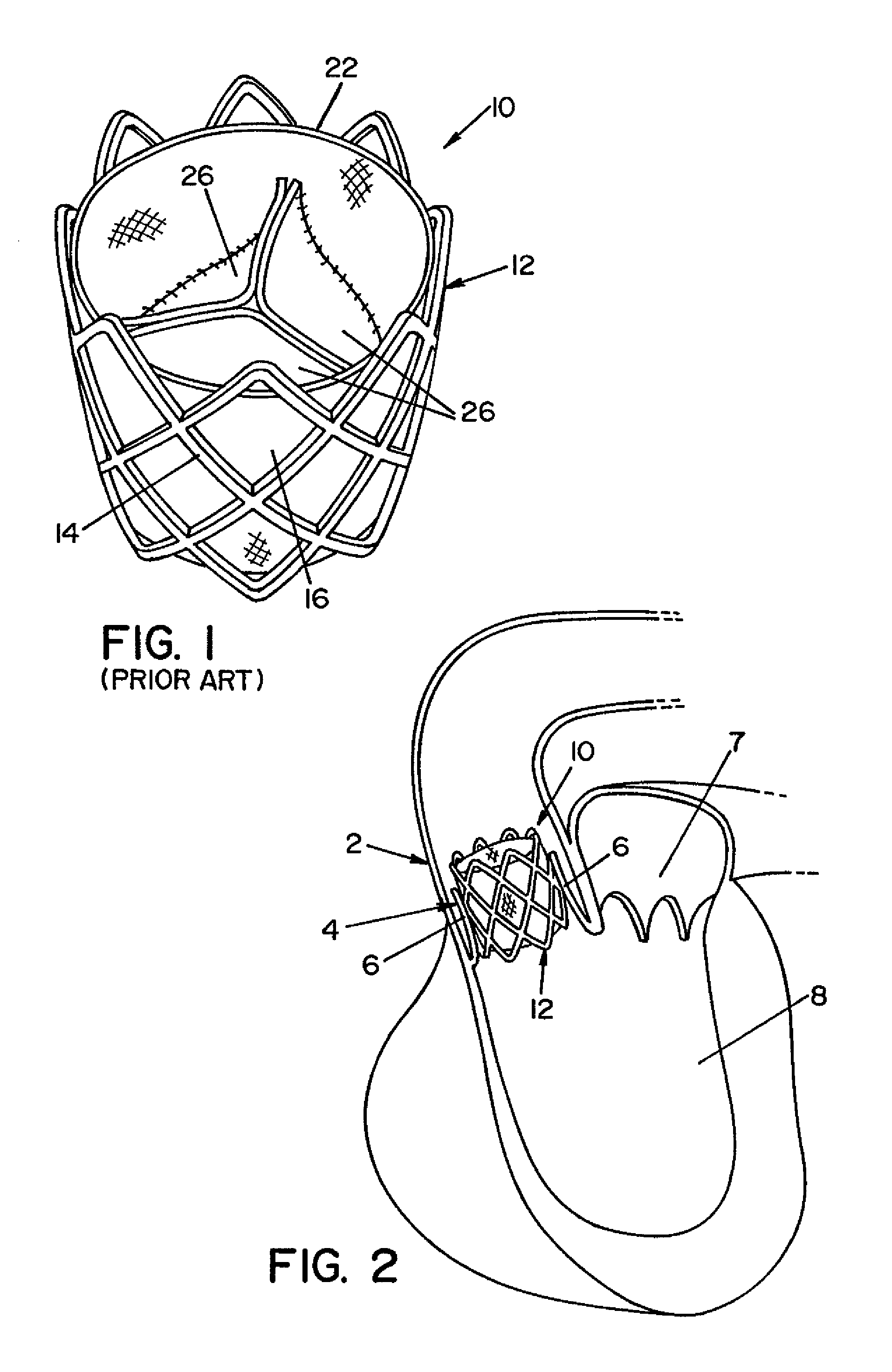 Method and apparatus for prosthetic valve removal