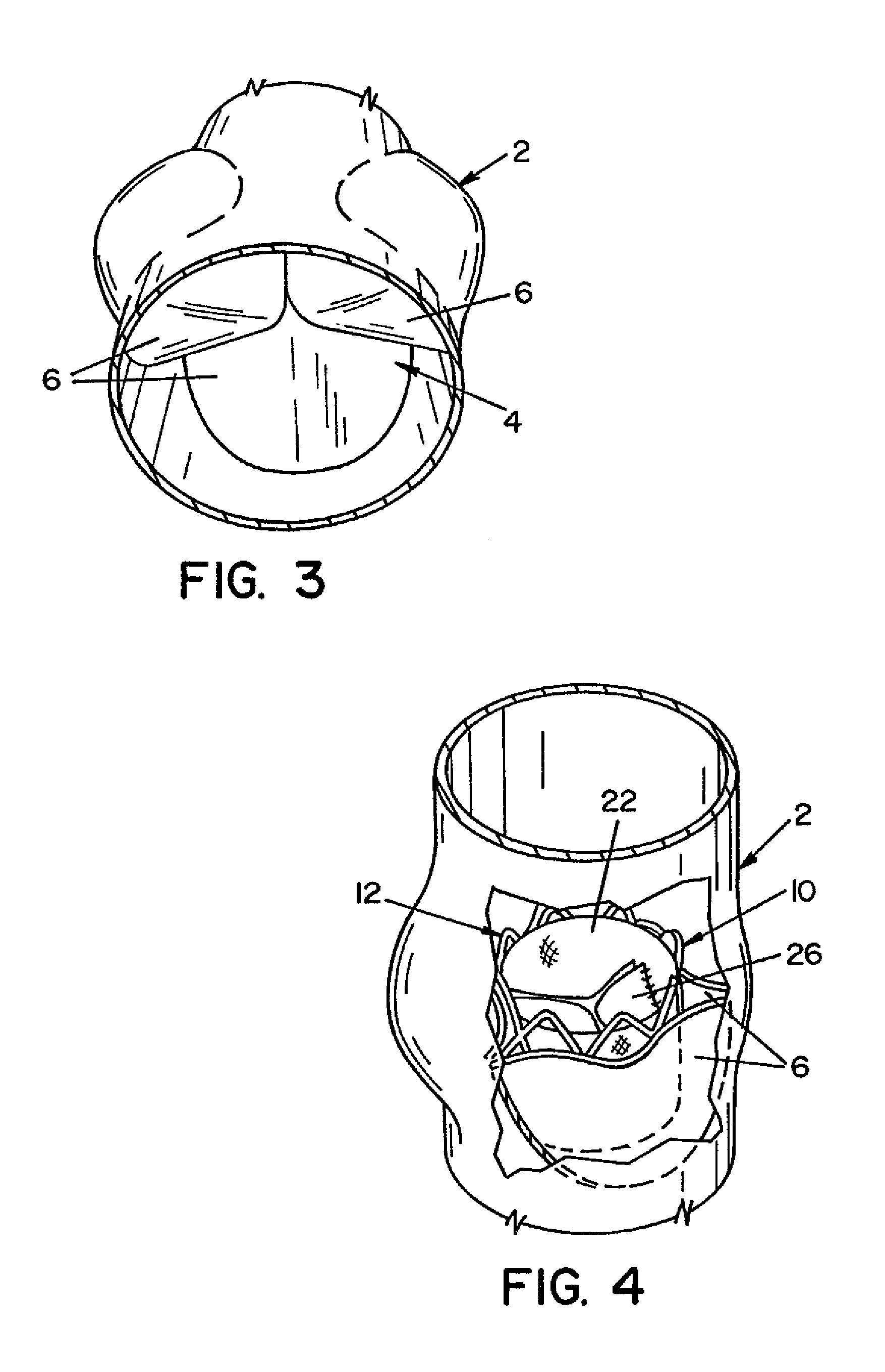 Method and apparatus for prosthetic valve removal
