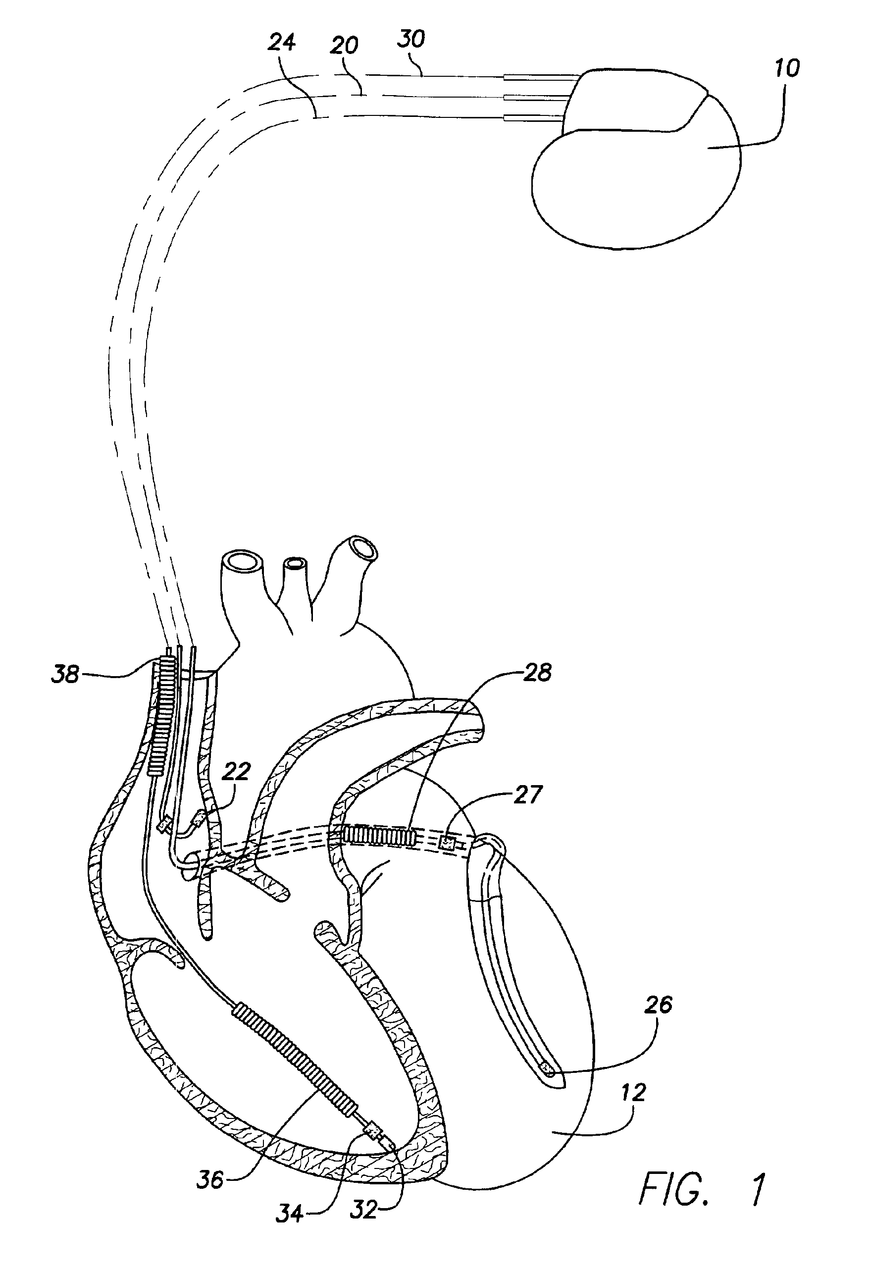 Implantable cardiac stimulation device that defibrillates the atria while avoiding the ventricular vulnerable period and method