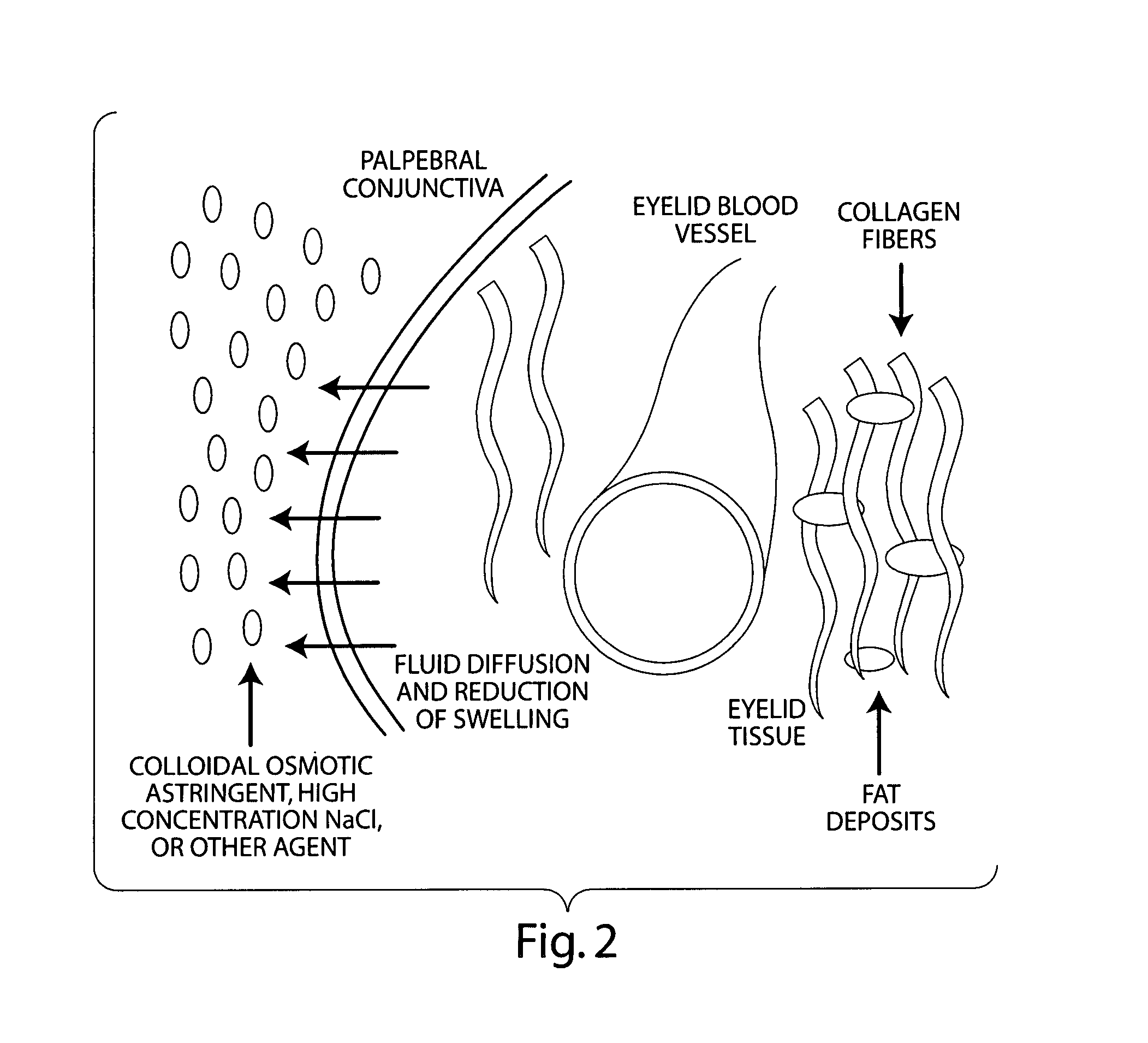 Compositions for the treatment and prevention of eyelid swelling