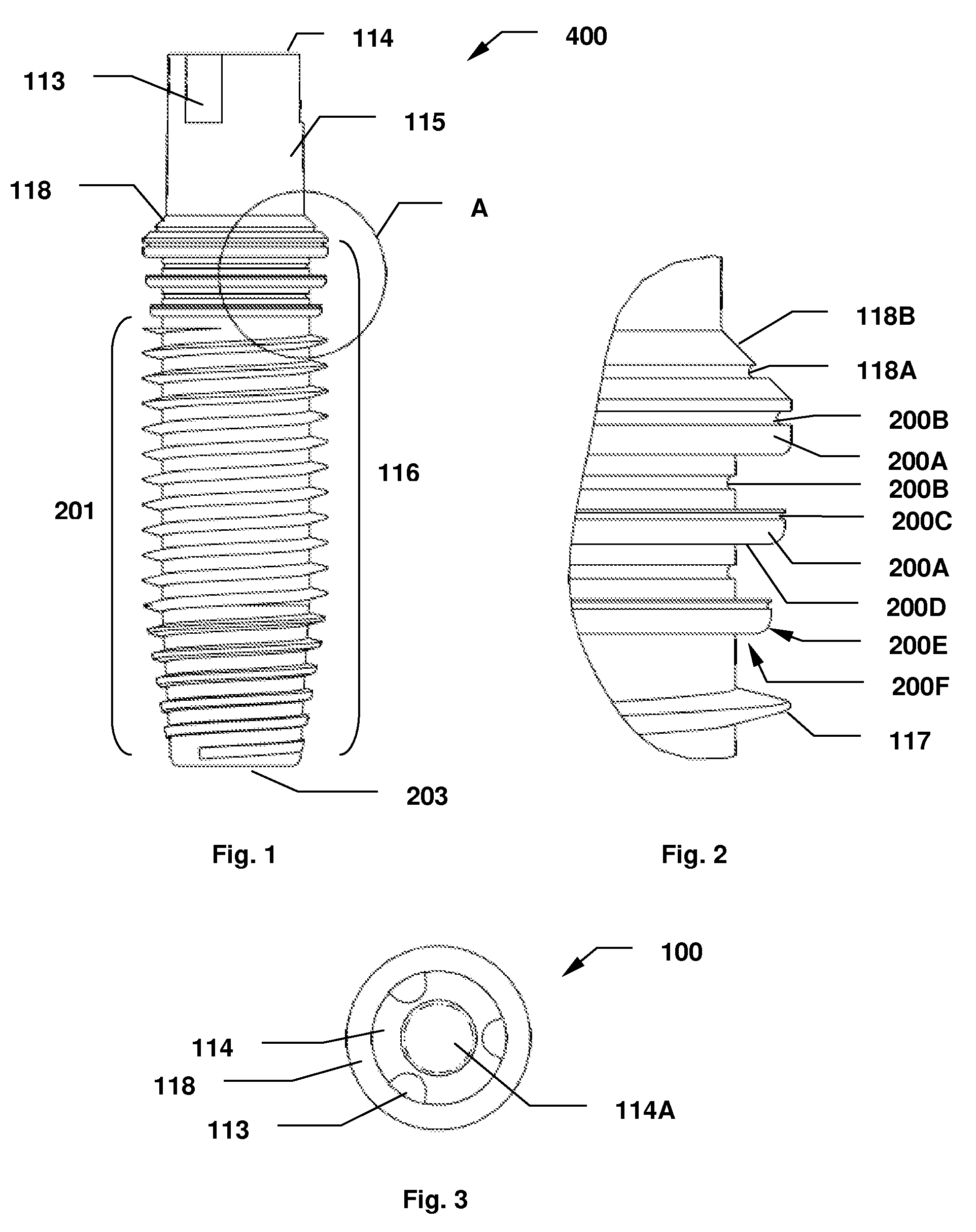 Dental implant system and method