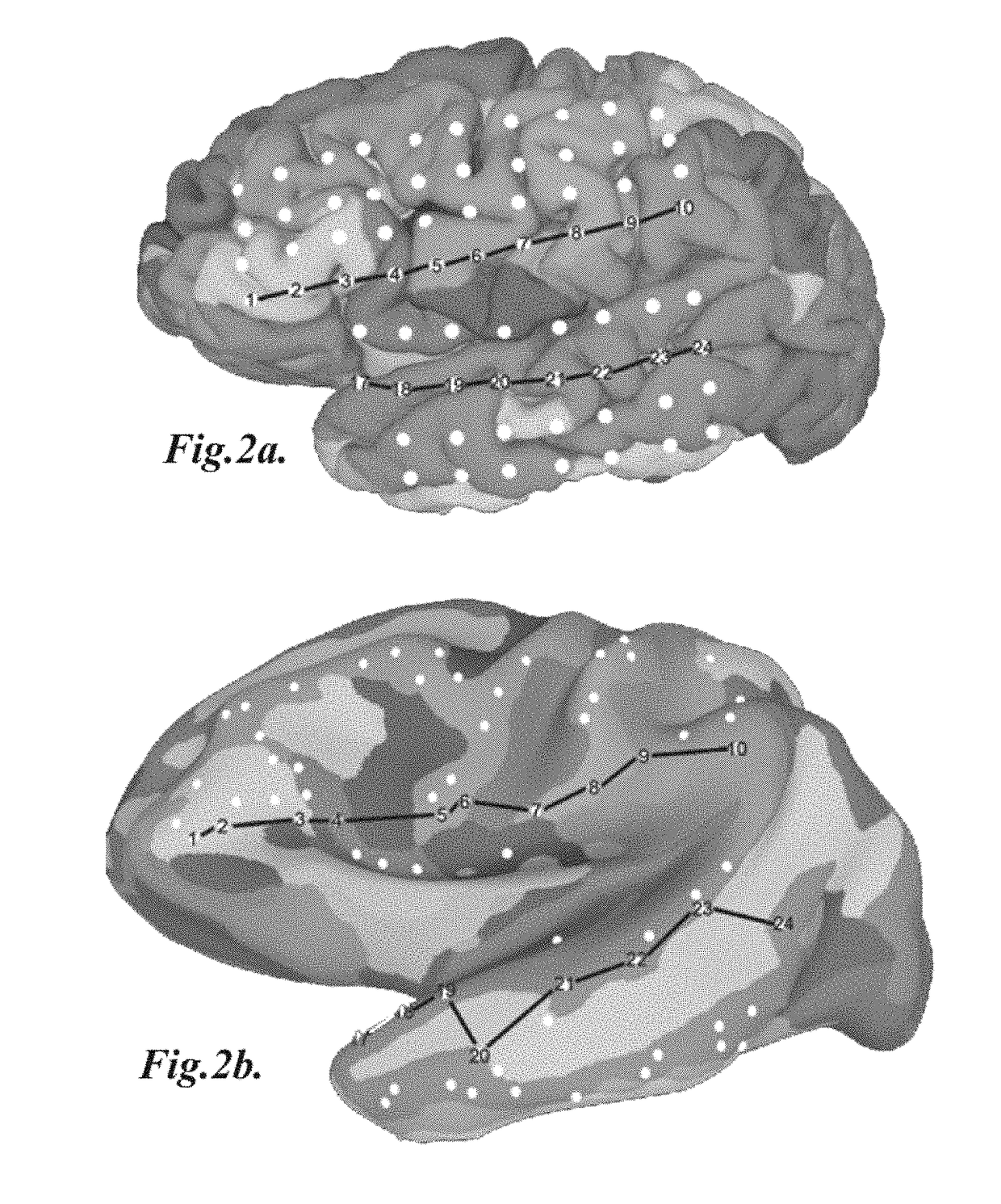 Subdural electrode localization and visualization using parcellated, manipulable cerebral mesh models