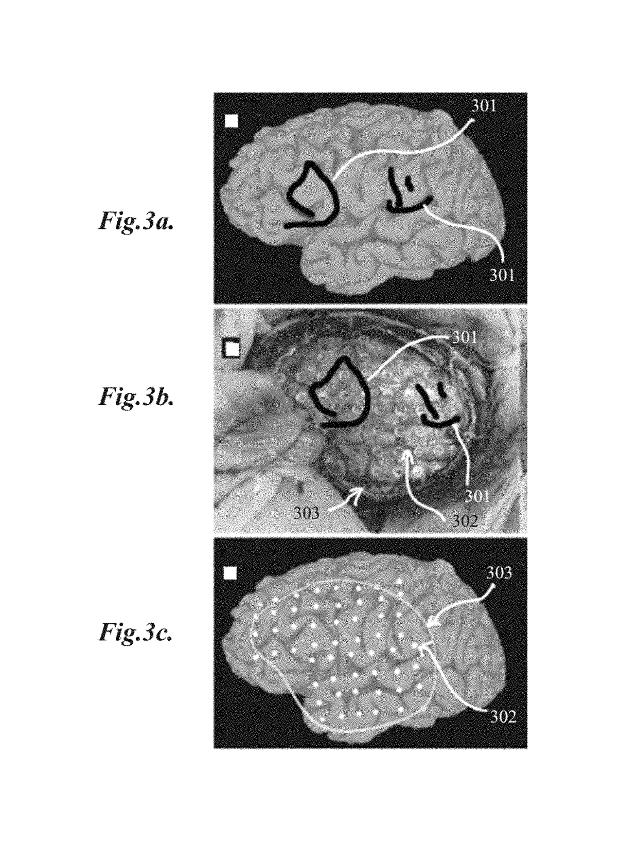 Subdural electrode localization and visualization using parcellated, manipulable cerebral mesh models