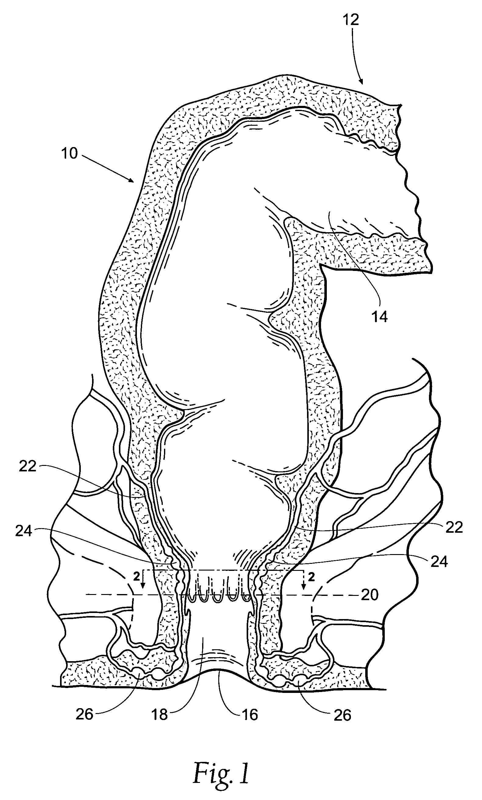 Systems and methods for treating hemorrhoids